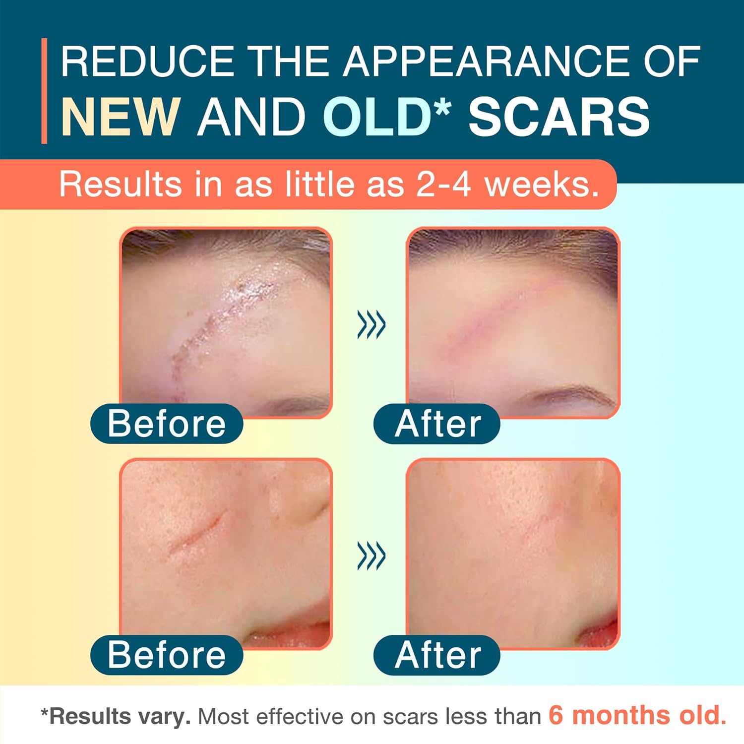 Silicone Scar Sheets, 1.55” x 78” - 2M Roll, Reusable Silicone Scar Tape, Medical Scar Strips for C-Section, Keloid Bump, Stretch Marks, Burn, Acne, Tummy Tuck, Surgical Scar Removal - Image 3