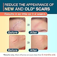 Vista 3 de Hojas de silicona para cicatrices, rollo de 1.55 x 78 pulgadas, cinta de silicona reutilizable para cicatrices, tiras médicas para cicatrices