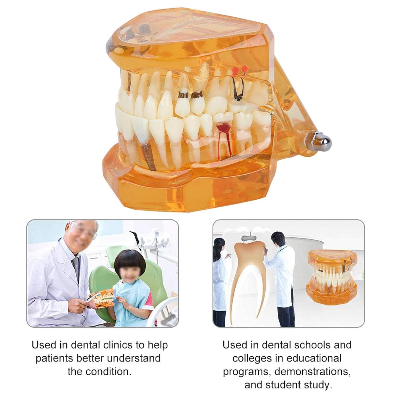 Modello di Insegnamento dello Studio Rimovibile di Malattie Dentali, Modello per Programmi Scolastici di Odontoiatria, Modello di Impianto Dentale, Strumento Dimostrativo