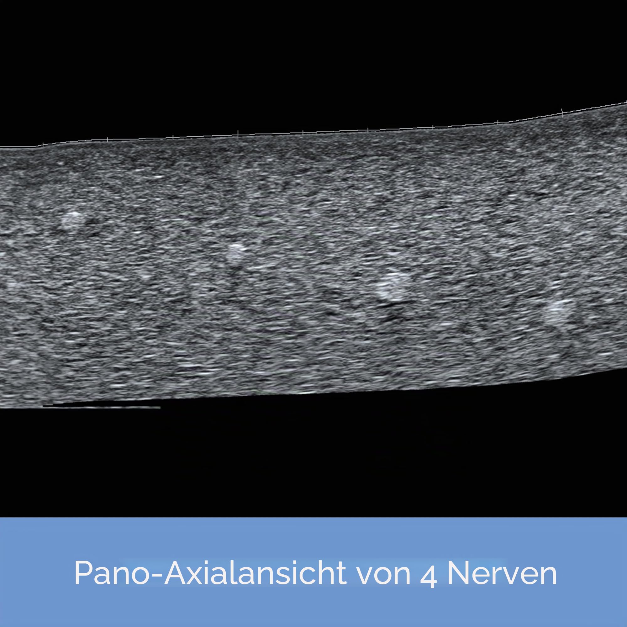 Ultraschall-Phantom-Trainingsmodell für die medizinische Praxis, Nervenblocksimulation (Nervenmodell)