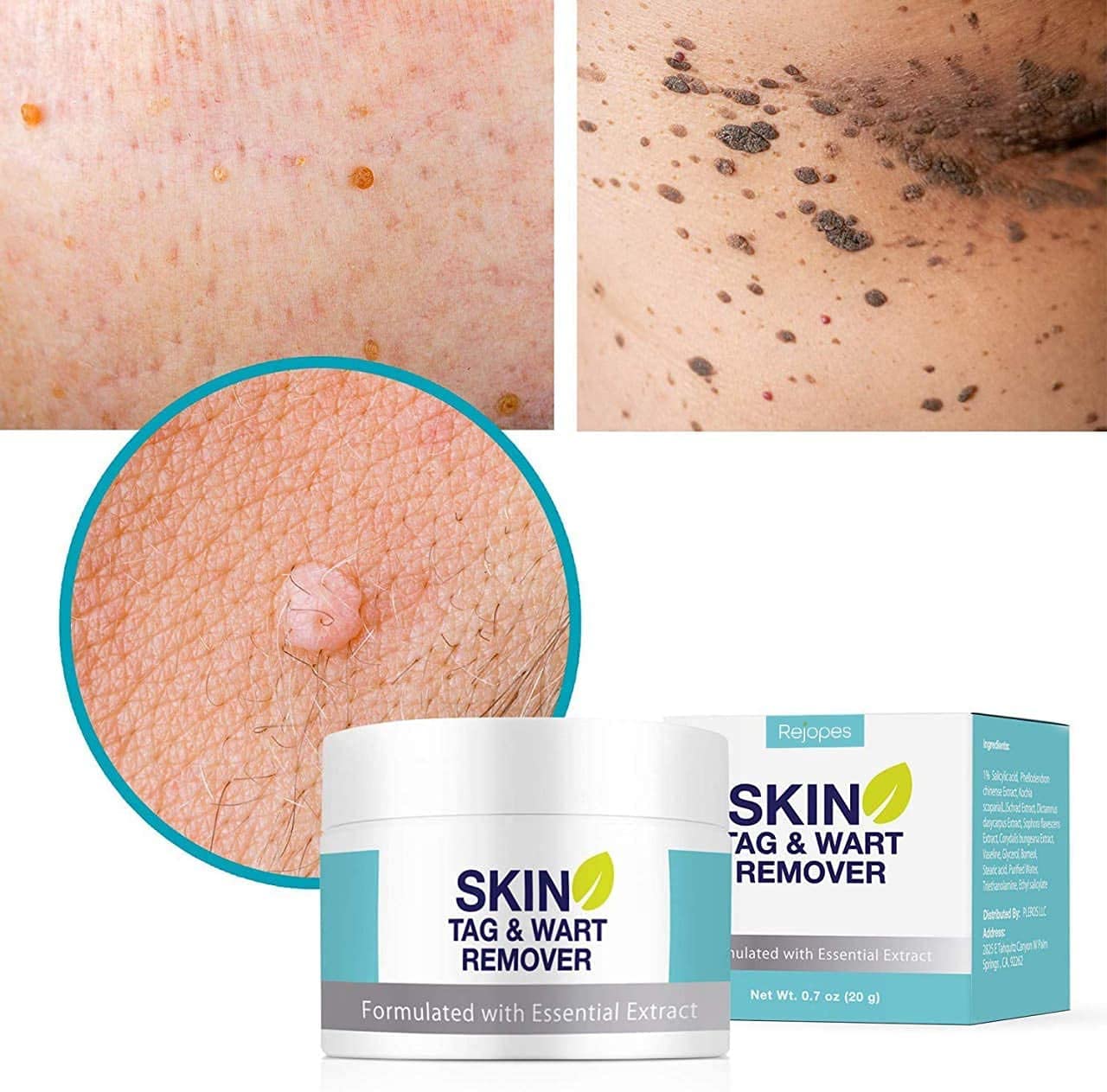 Skin Tag Remover, Warts & Mole Remover Cream, Skin Tags Dry and Fall
