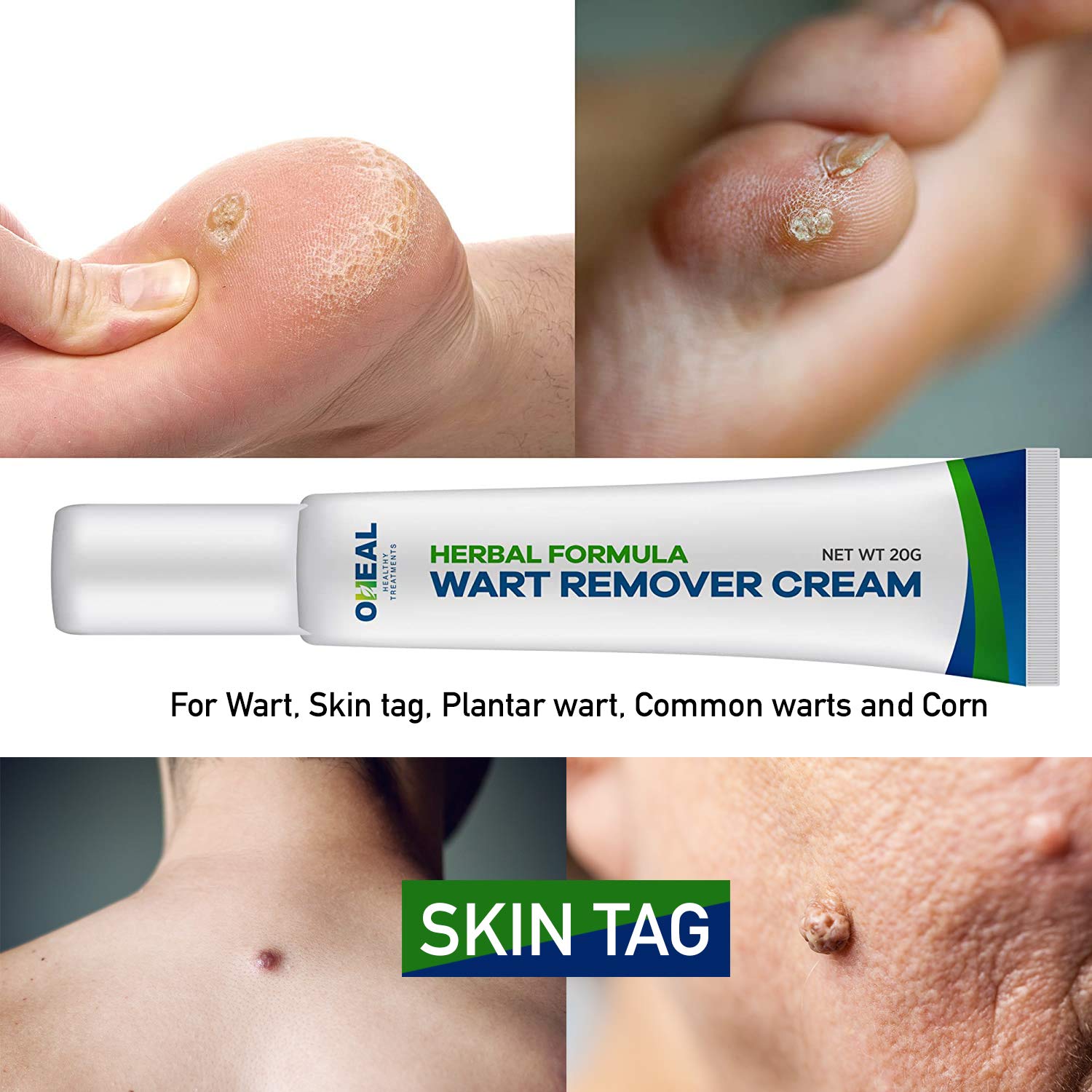 Buy Wart Remover Cream, Skin Tag Remover for Warts, Skin Tag, Plantar