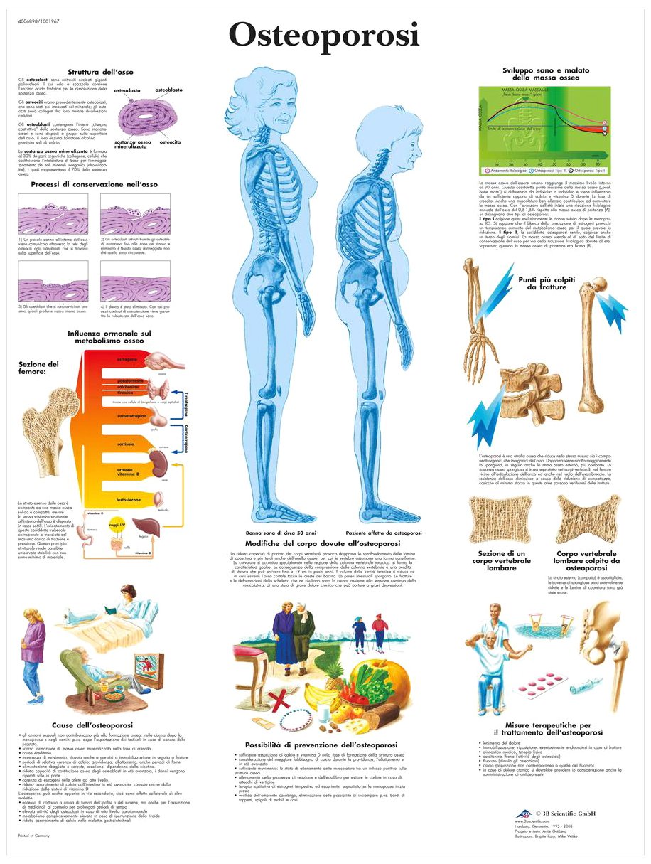 3B Scientific VR4121UU Osteoporosis