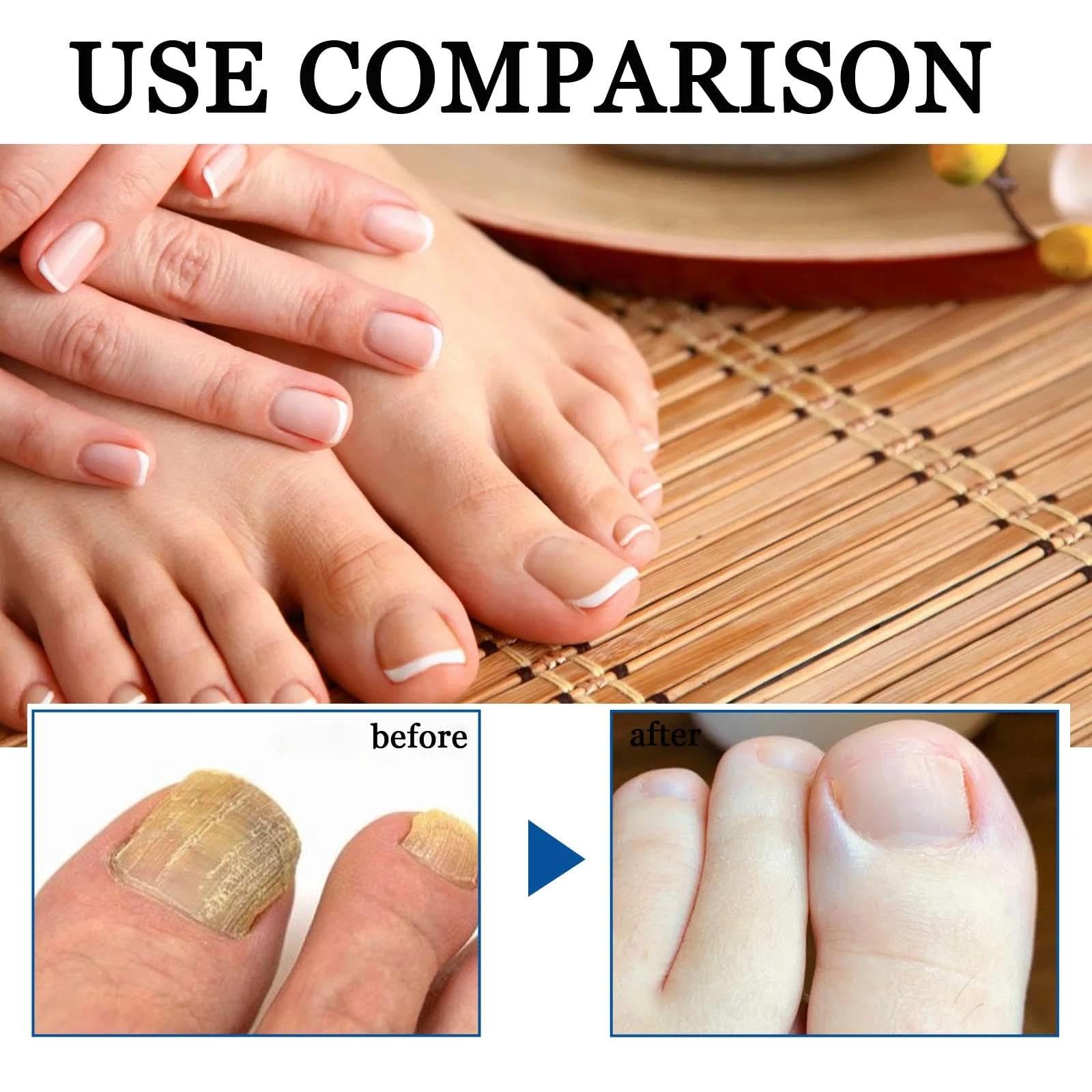 A Speedy and Effective Approach to Toenail Issues - Combating Thick, Discolored Nails - Powerful Solution for Addressing Yellow and Brown Nails - Image 3