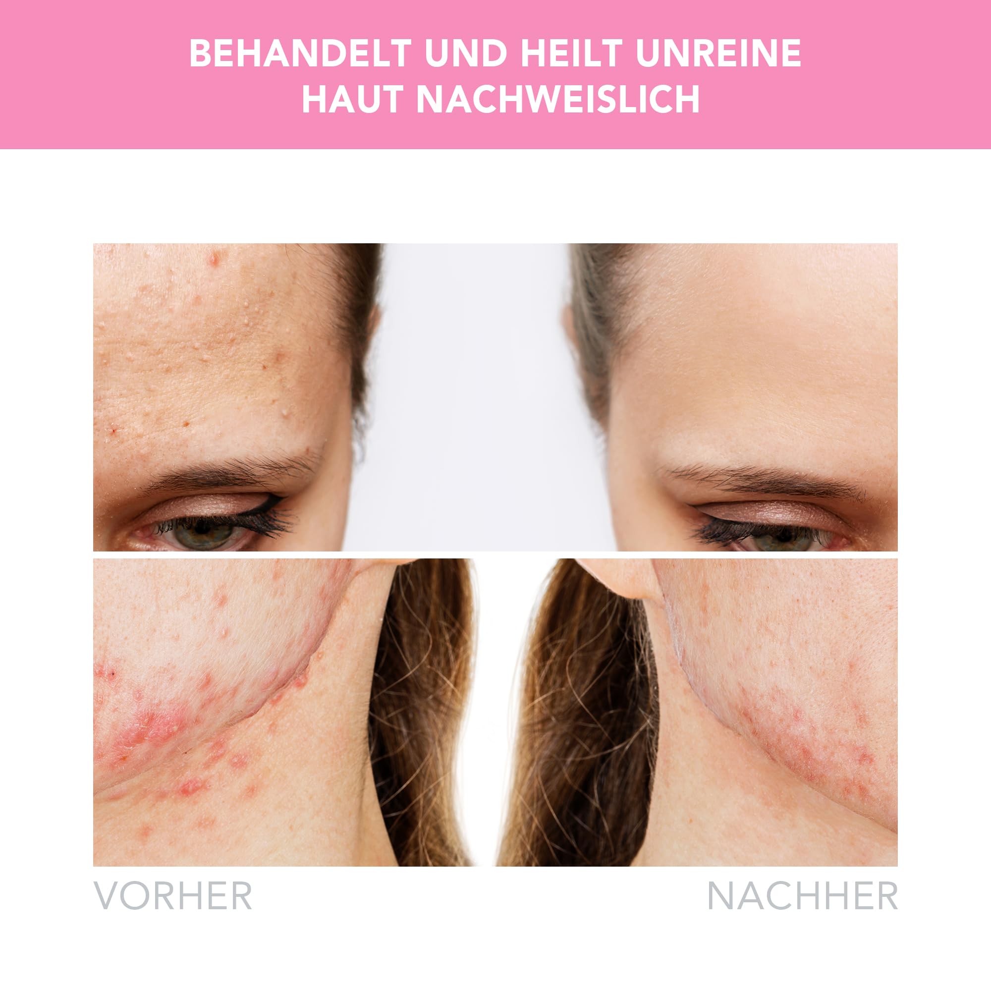 FOREO ESPADA 2 LED – Pflegegerät zur Behandlung von Unreinheiten – Medizinisches Silikon – Narbenbehandlung – Entfernung von Pickeln und Hautunreinheiten – FDA-zugelassen – Pearl Pink