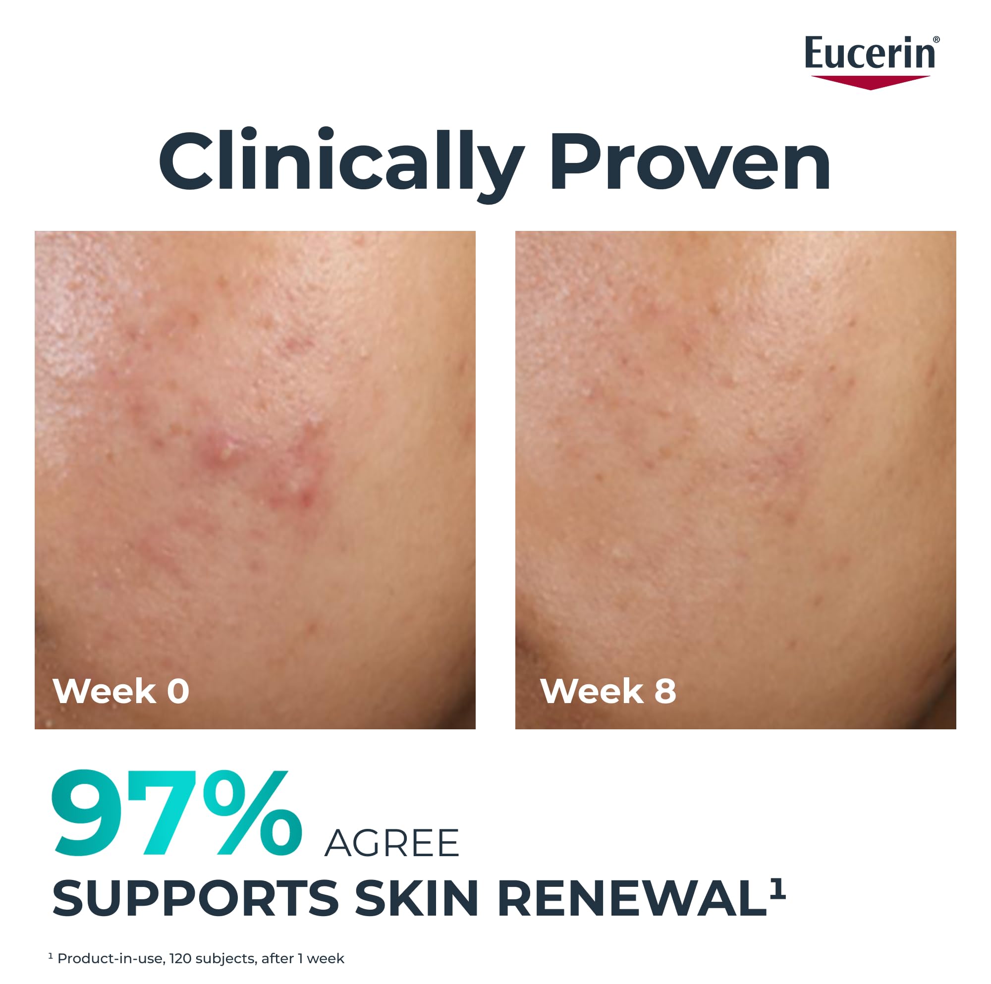 Eucerin Dermopure Clinical Peeling 10 Treatment 40ml, Renewing Facial Serum with 10% Dermo-Acids and Salicylic Acid - Image 2