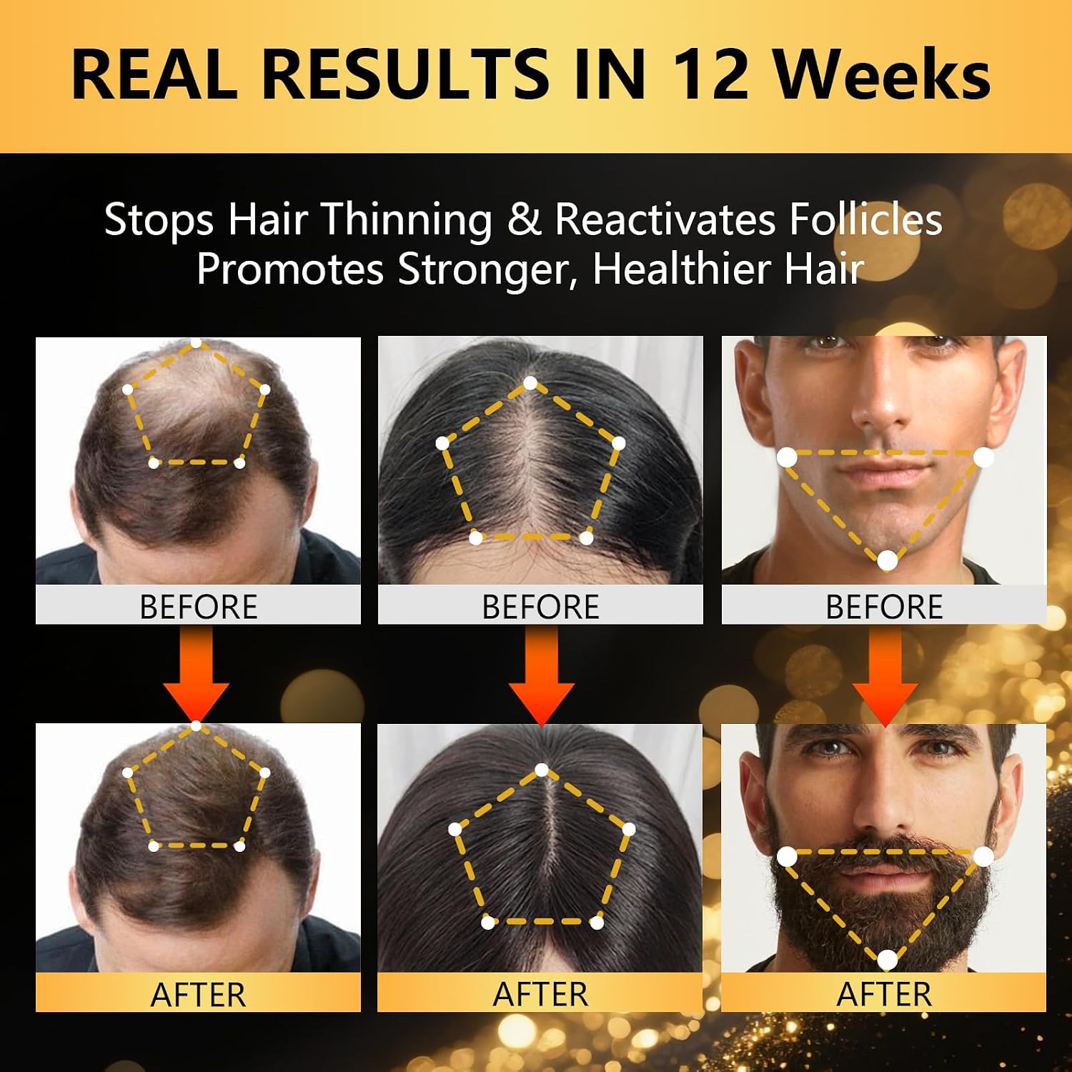 5% Minoxidil for Men,Minoxidil for BeardGrowth Kit, Minoxidilfor Women HairGrowth Kit, HairRegrowth for Men,Beard Growth Serum,with Rosemary forThicker Hair Growth 60ML (1 Pack)