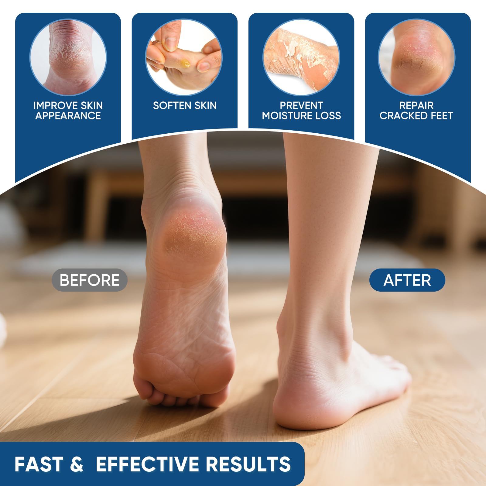 Urea Cream 40% & Salicylic Acid - Heal Dry Heels -4