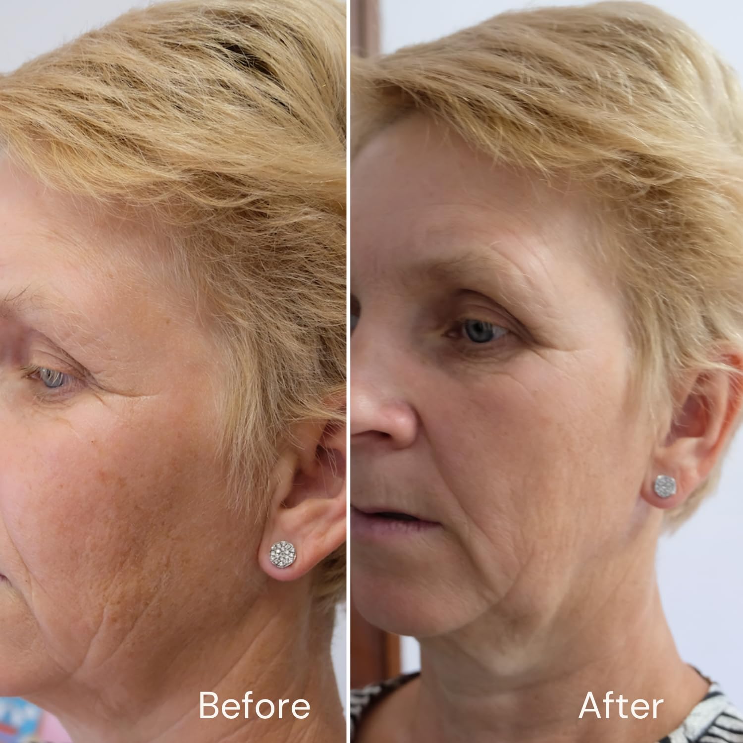 Retinol-Serum 2,5 % – 4 x stärker als Anti-Aging- und Anti-Akne-Behandlungen. Mit 11 % Hyaluronsäure und 20 % Vitamin C, stärkere Leistung.