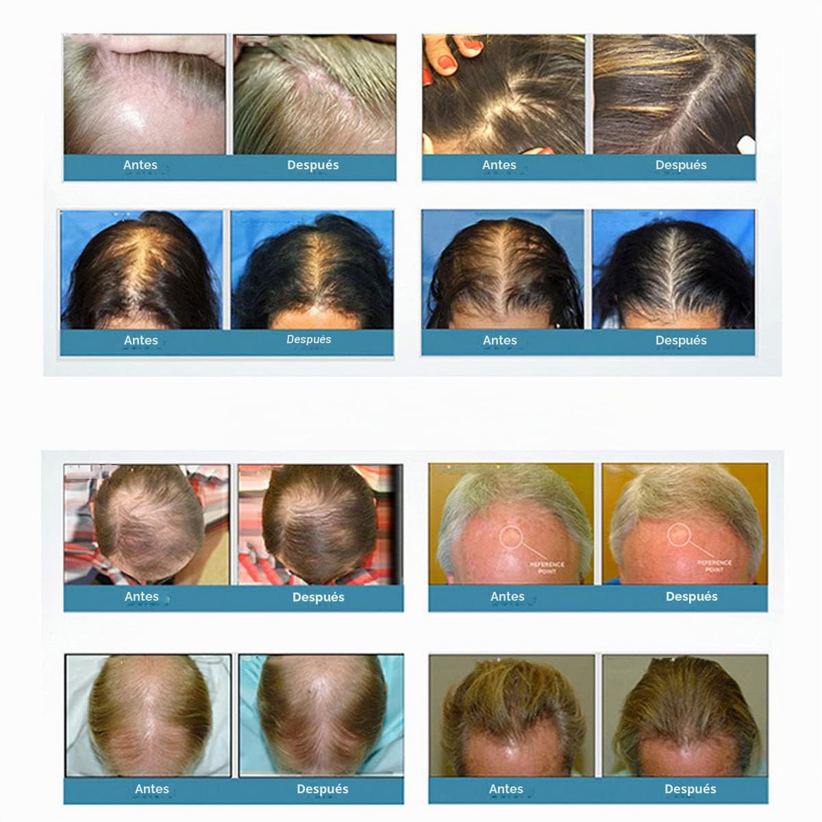 PRO LH272 Casco láser para tratamientos de pérdida de cabello en hombres y mujeres estimulan el crecimiento del cabello, regeneración más densa
