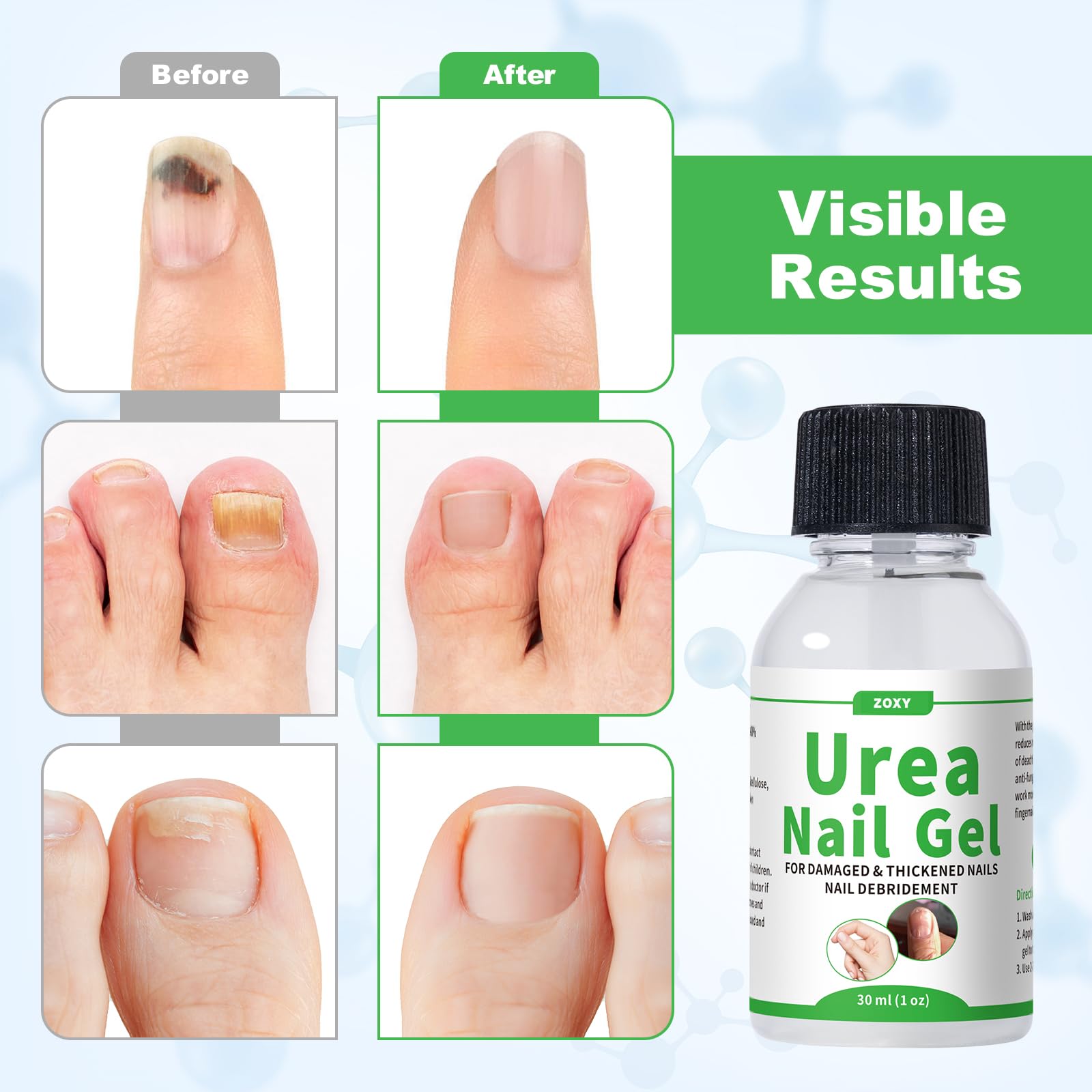 50% Urea Nail Gel for Thick Nails, Calluses and Rough Skin