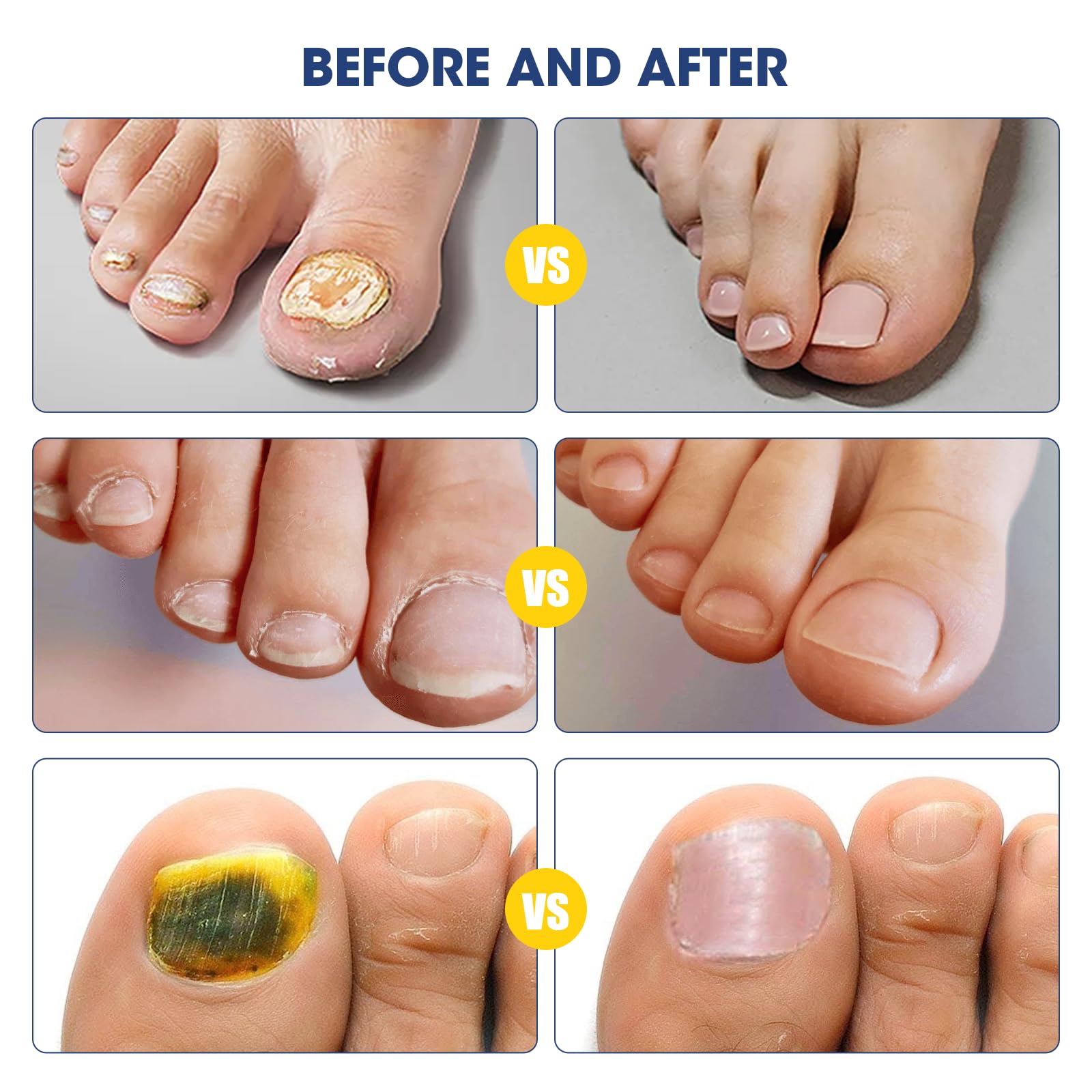 Fungal Nail Treatment For Toenails Extra Strong,MQUPIN Nail Fungus Treatment For Toenail & Finger - Image 4