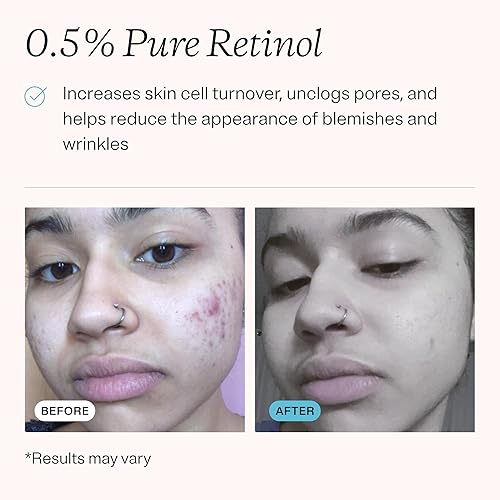 Miniatura 3 de MDacne Retinol 0,5% y crema de niacinamida al 4%, reduce las imperfecciones y mejora la textura de la piel sin irritación