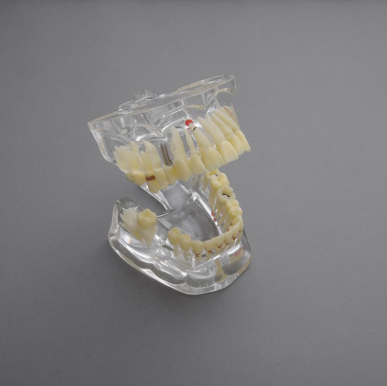 J&J Ortho General Adult Pathology Dental Model