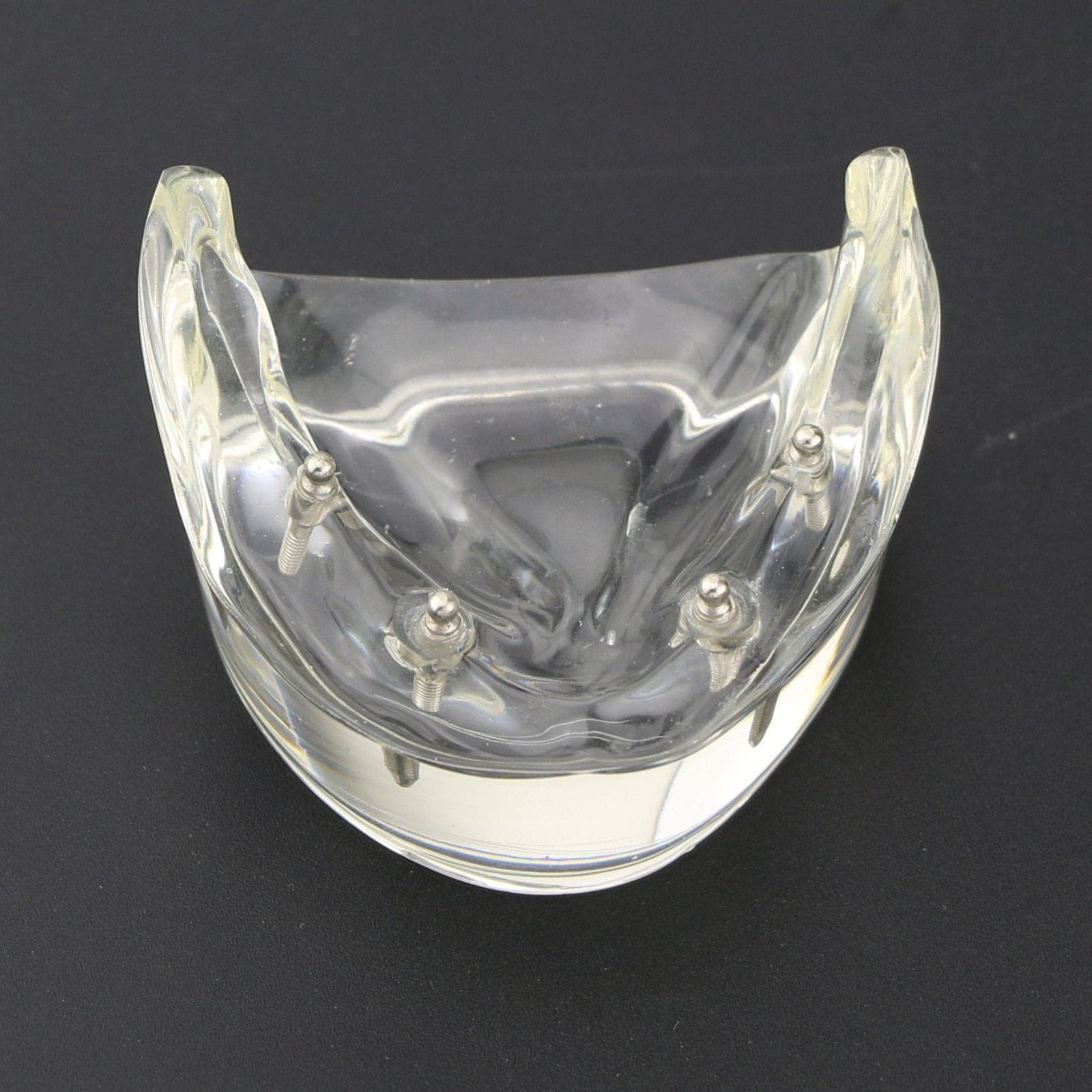 Modelo de sobredentadura Dental, modelo de dientes de enfermedad de implante, demostración de 2 implantes, para enseñar, estudiar, mostrar, comunicación con el paciente