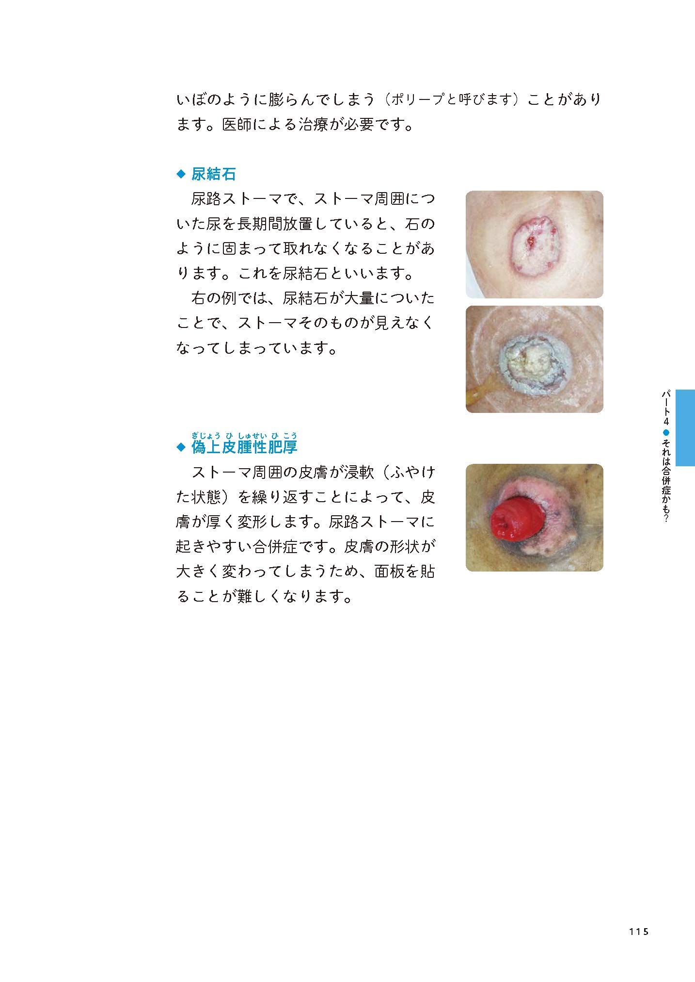 快適 ストーマ生活 第2版 日常のお手入れから旅行まで 松浦信子 山田陽子 本 通販 Amazon