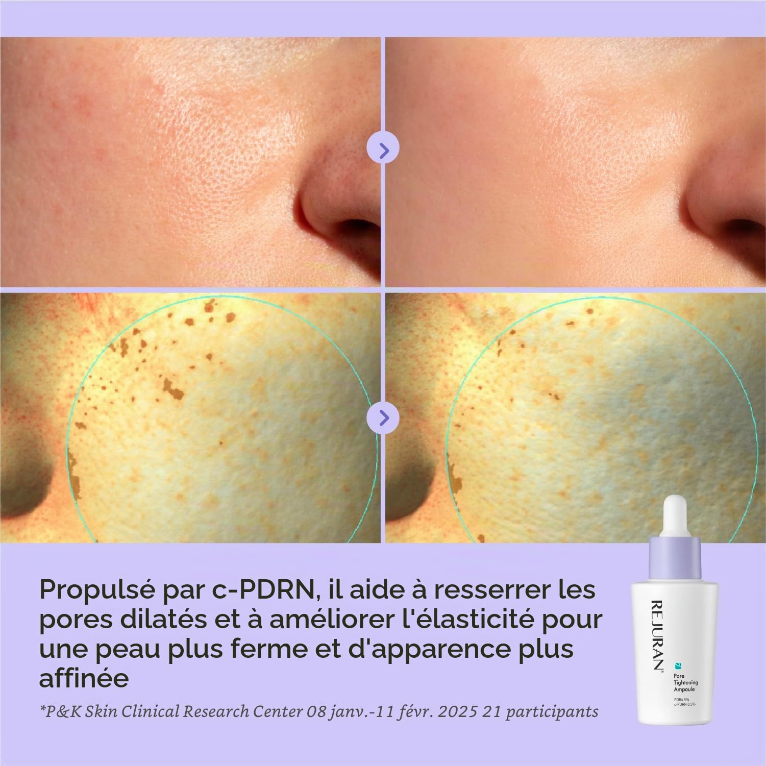 REJURAN Ampoule Resserrant Les Pores Pdrx 5% & C Pdrn 0,5% Sérum Visage Aux Aha/Pha/Bha/Lha Et À L'Hamamélis. Aide À Affiner L'Apparence Des Pores. 30 Ml (1 Unité)