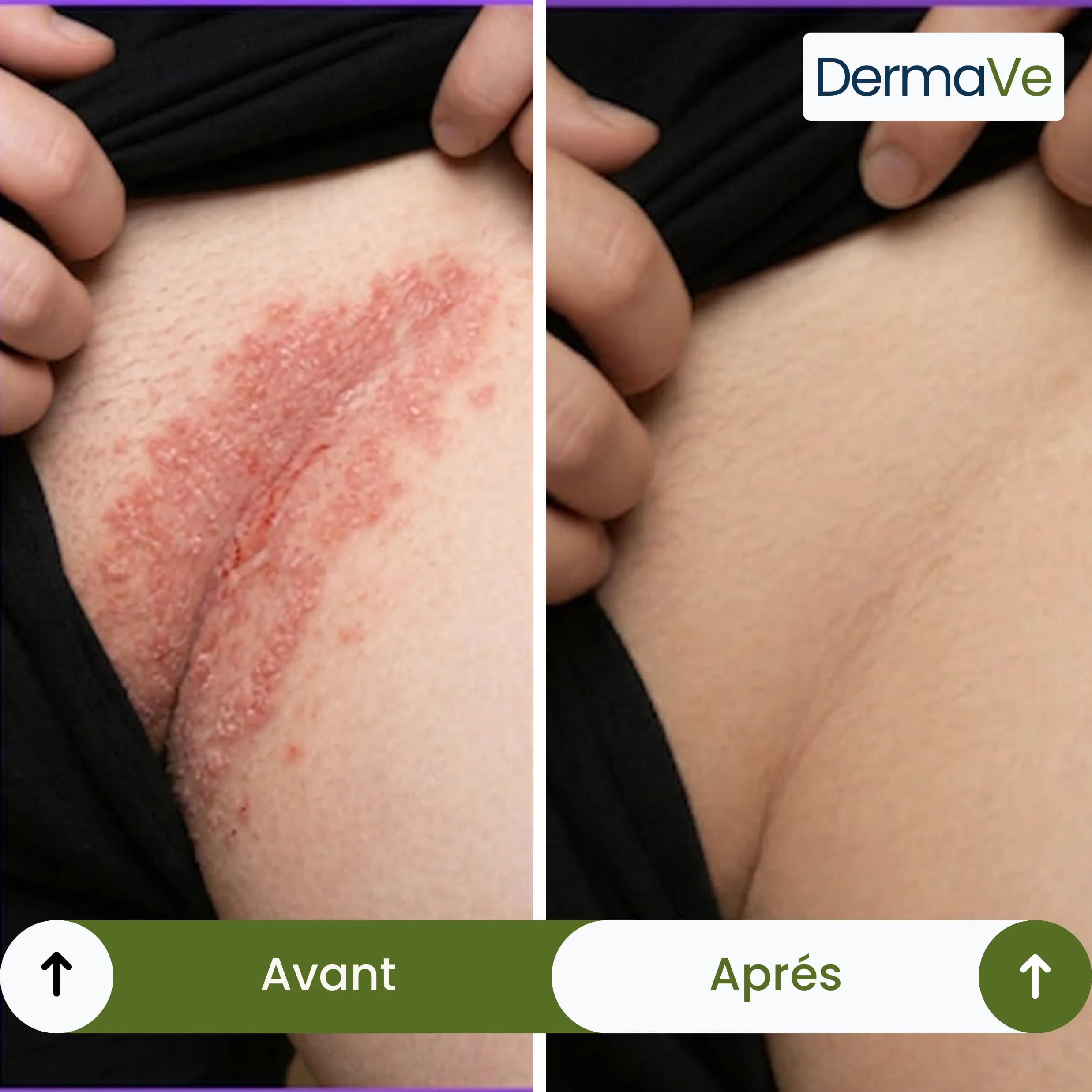 Savon antifongique Dermave Savon solide purifiant huile d'arbre à thé – visage et corps pour peaux à problèmes, nettoie en profondeur, régule le sébum, parfum frais