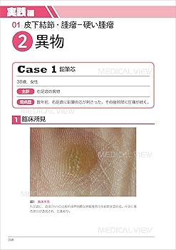 しこりをみたらどう考える? : 日常診療で遭遇するしこりへの対応法 しこりをみたらどう考える? : 日常診療で遭遇するしこりへの対応法