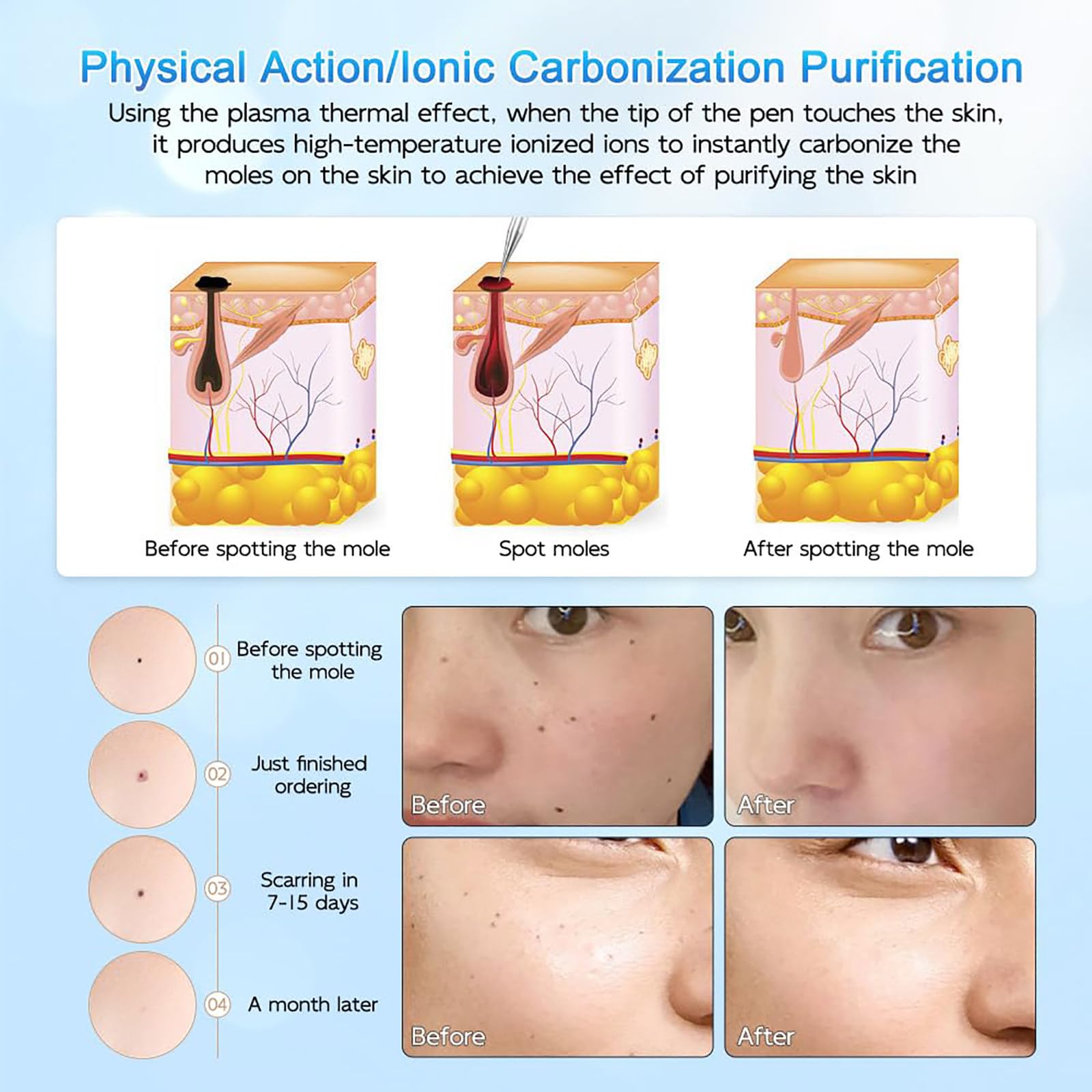 BolíGrafo Profesional para Eliminar Lunares, BolíGrafo De Plasma, con Luz Roja Y Azul para El Cuidado De La Piel, 9 Niveles De Ajuste, Se Utiliza para Eliminar Pecas, Lunares, Verrugas