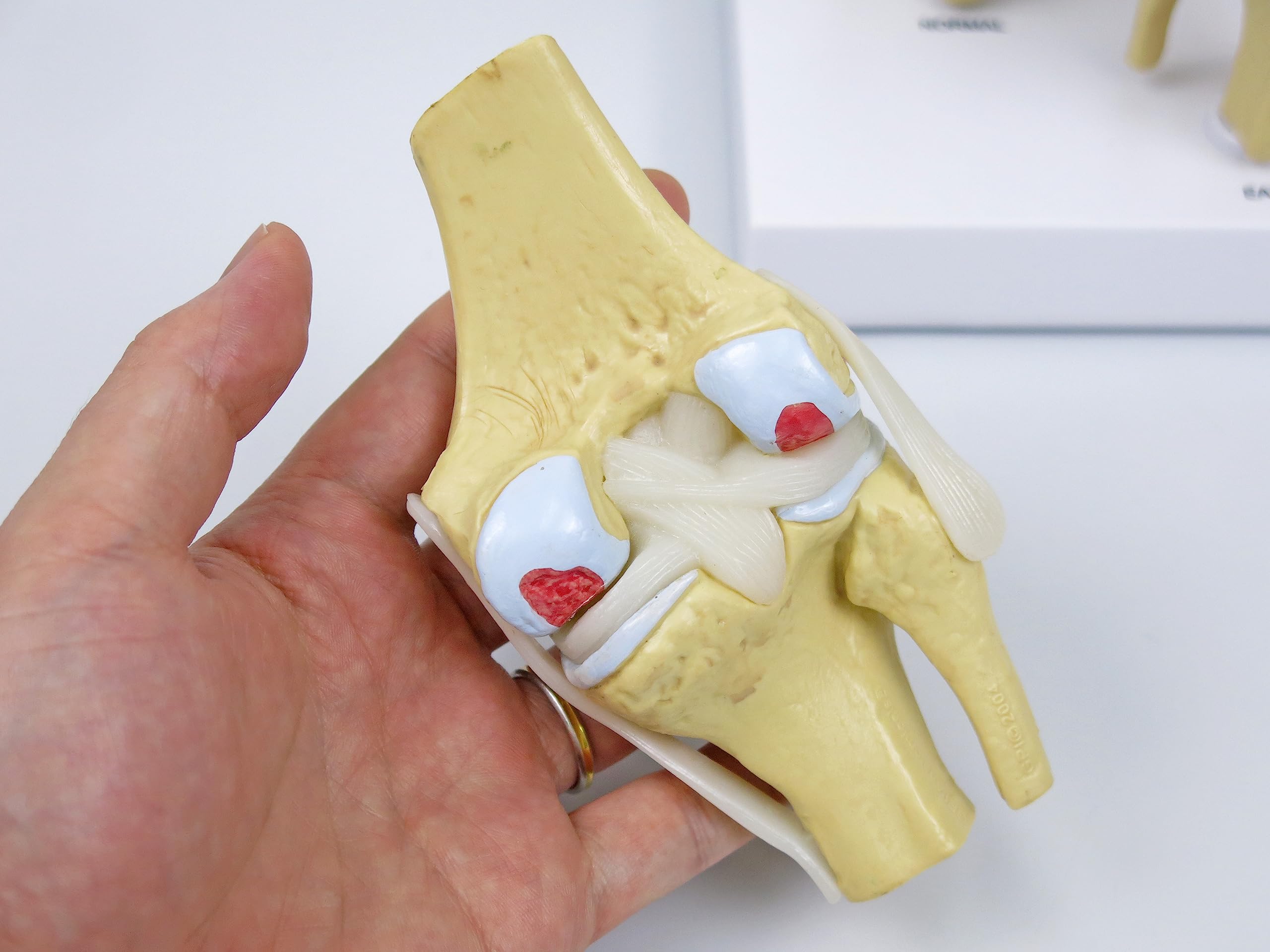 GPI Anatomicals 1100 Osteo-Kniemodellset 4 verschiedener Stadien