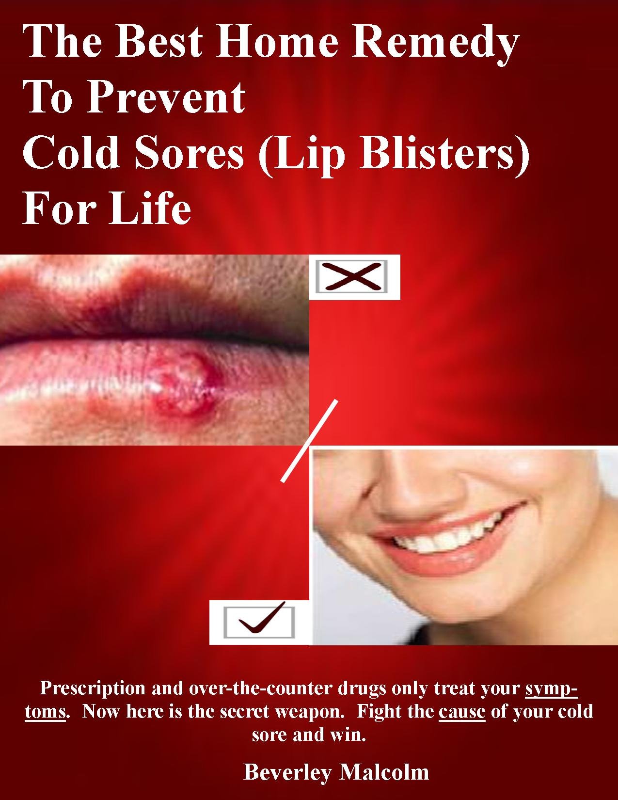 The Best Home Remedy to Prevent Cold Sores (Lip Blisters) for Life