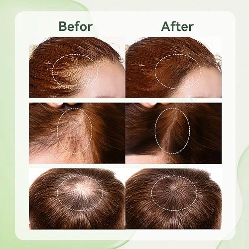 Miniatura 6 de Aceite de romero para el cabello + aplicador de aceite para el cuero cabelludo, kit de crecimiento del cabello con aceite de romero de 2 onzas x 2 y