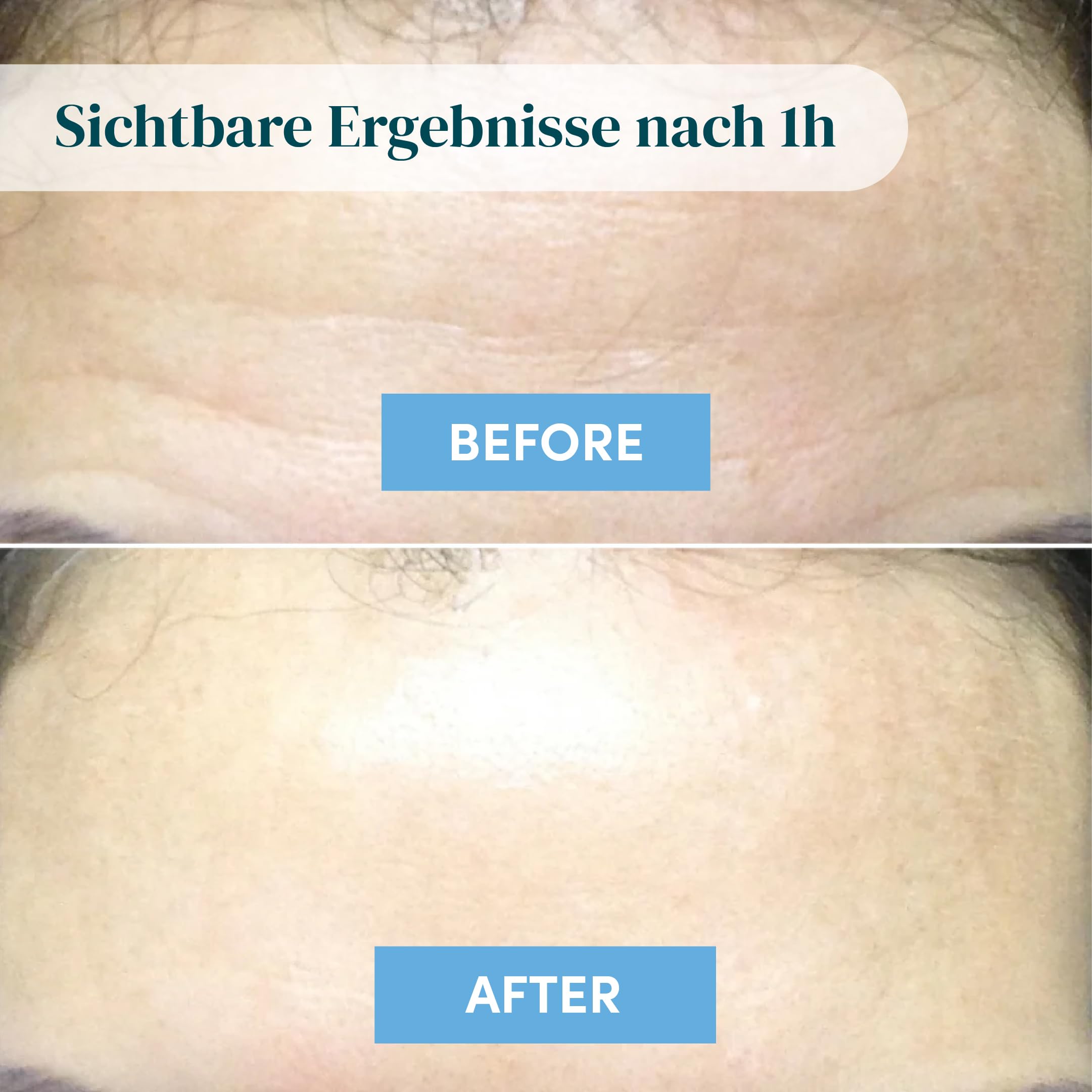 APRICOT Stirn Pads gegen Falten 2x aus medizinischem Silikon mit niedermolekularem Hyaluron, Stirn- und Zornesfalte Glätten - 60x Wiederverwendbar, Dermatologisch geprüft, Vegan & Tierversuchsfrei