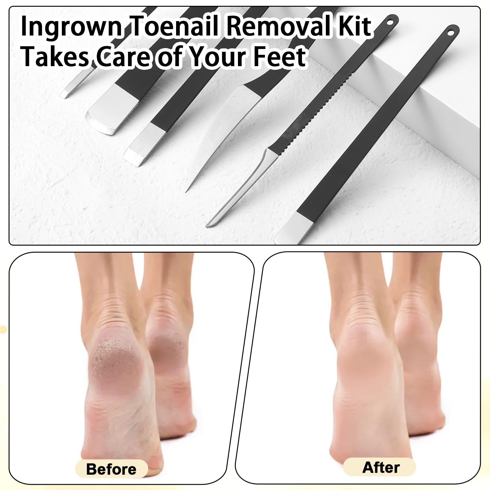 Zestaw do usuwania wrastających paznokci u stóp, profesjonalne zestawy noży do pedicure, golarka do stóp ze stali nierdzewnej, z pudełkiem do przechowywania, narzędzia do pielęgnacji stóp, do