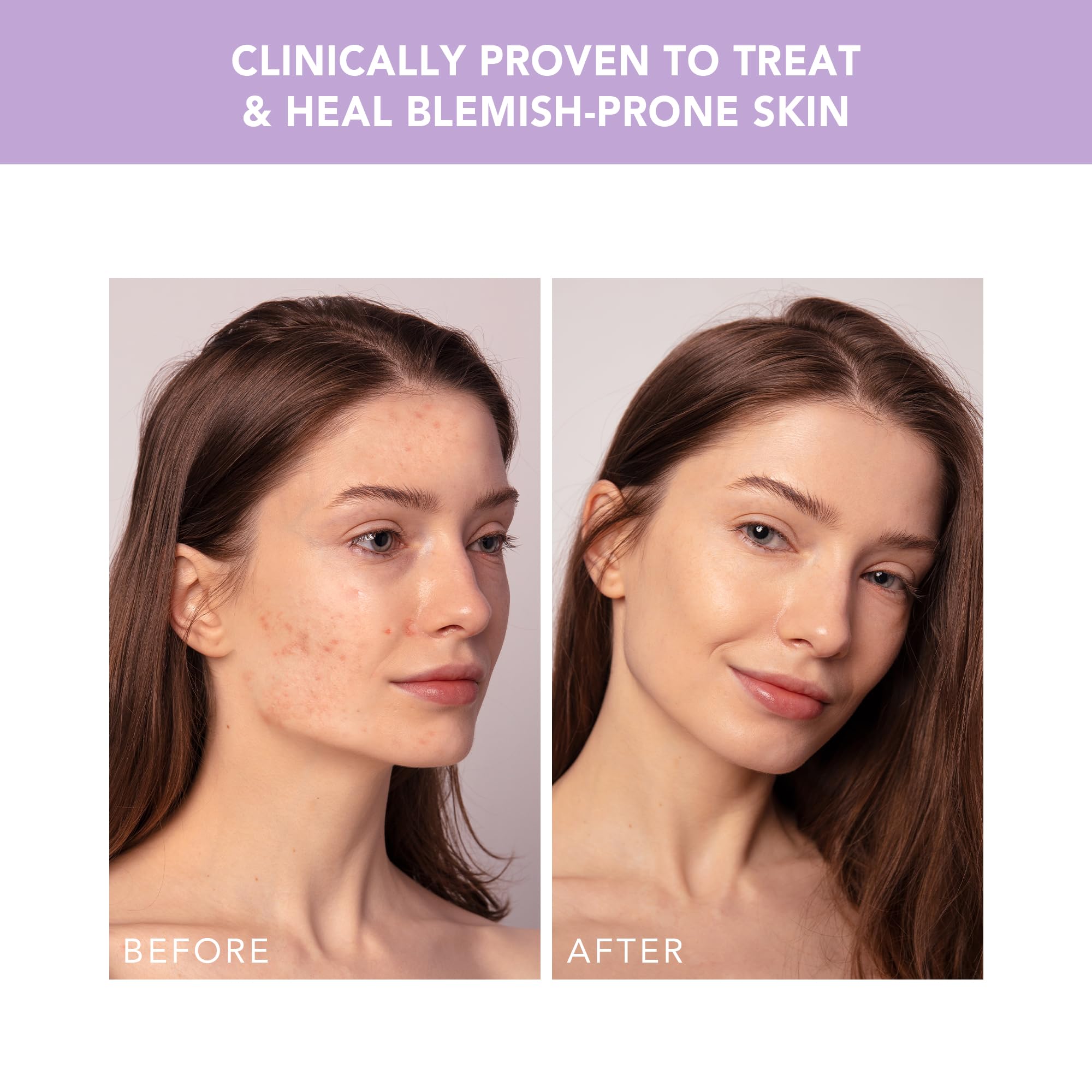 FOREO ESPADA 2 plus Precise Targeting - Skin Care Device for Blemish Treatment - Medical-grade Silicone - Scar & Spot Treatment for Face - Clear Skin – Lavender