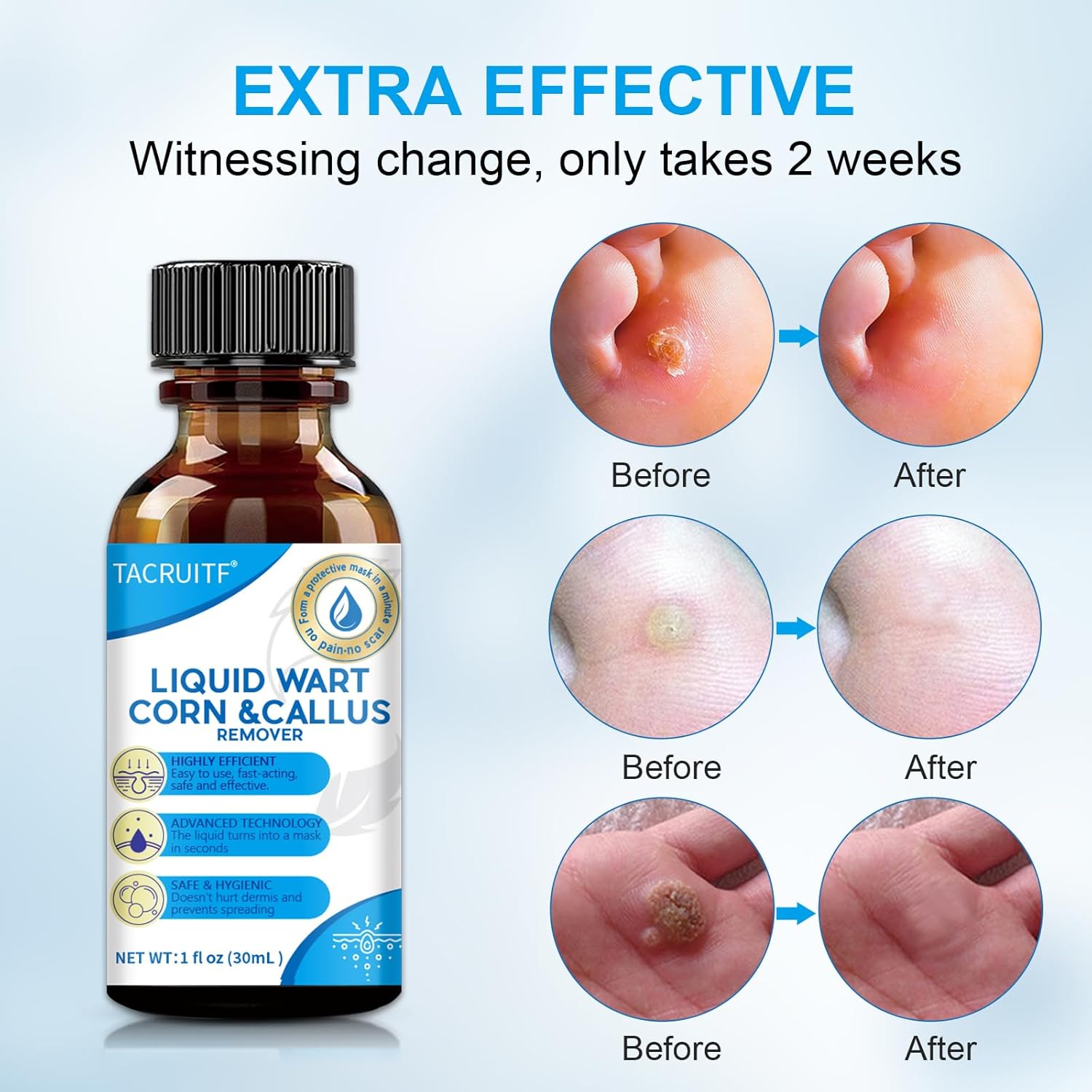 2 Packs Fast-Acting Salicylic Acid Remover: Strongest Wart Corn Removers for Feet, Body and Neck.Exclusive Formula 17% Salicylic for Plantar、Flat、Common Wart, Corn. For Men and Women - 2*30ML - Image 4