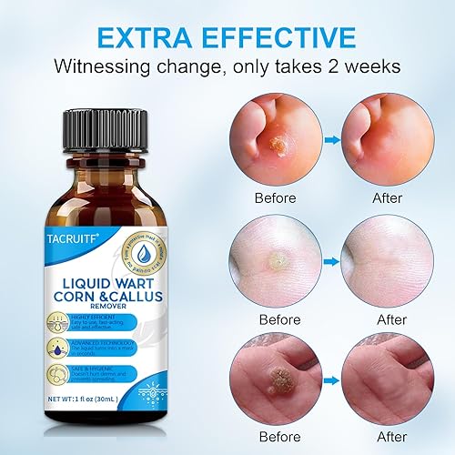 Miniatura 4 de Removedor rápido y suave de marcas cutáneas para cuello y cuerpo - Mezcla de ácido salicílico natural con punta de cepillo para una aplicación