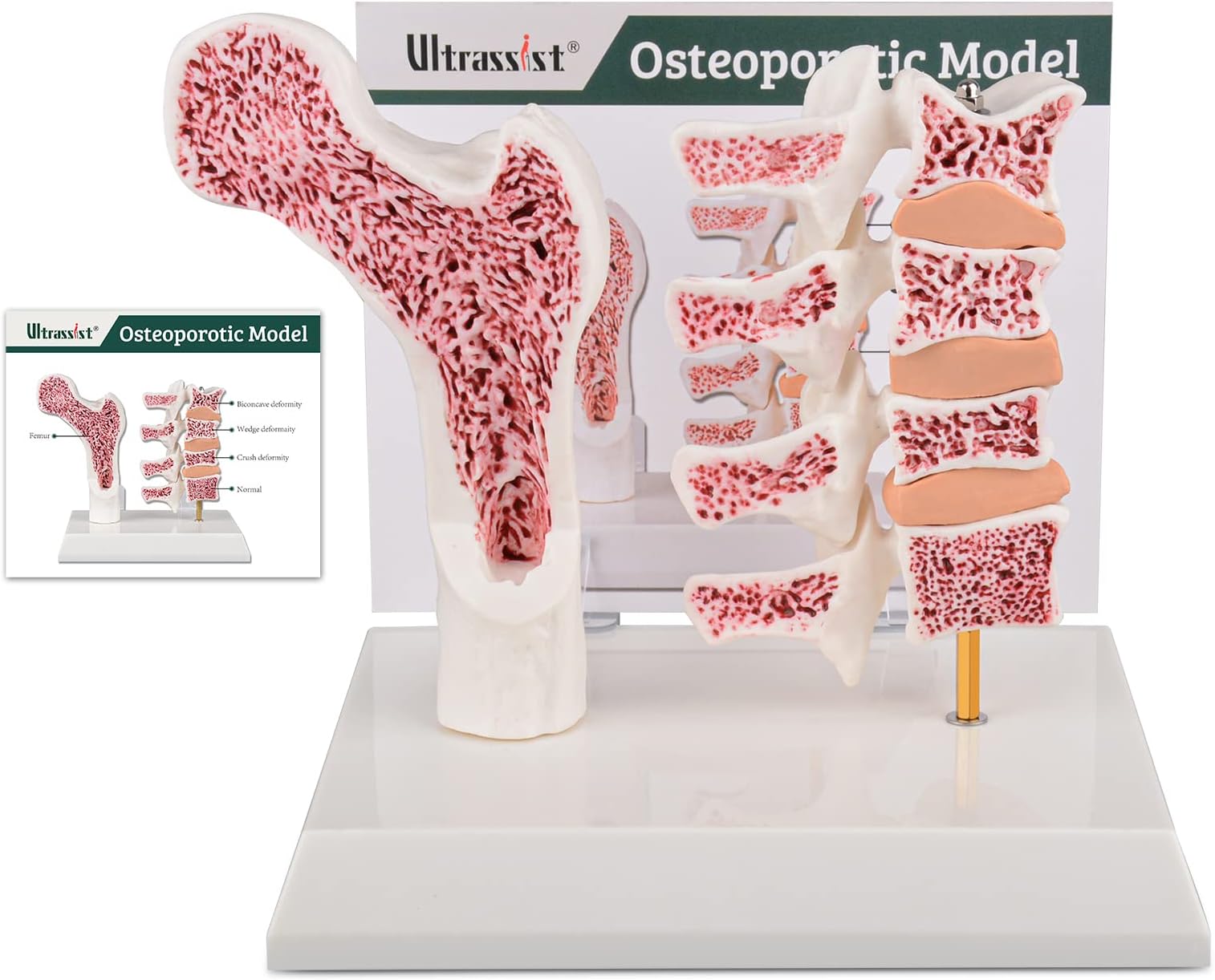 Ultrassist Osteoporosis Human Anatomy Model - Vertebrae Skeleton Sectional Model with Study Card for Medical Teaching Demonstration, Medical Students & Healthcare Educators