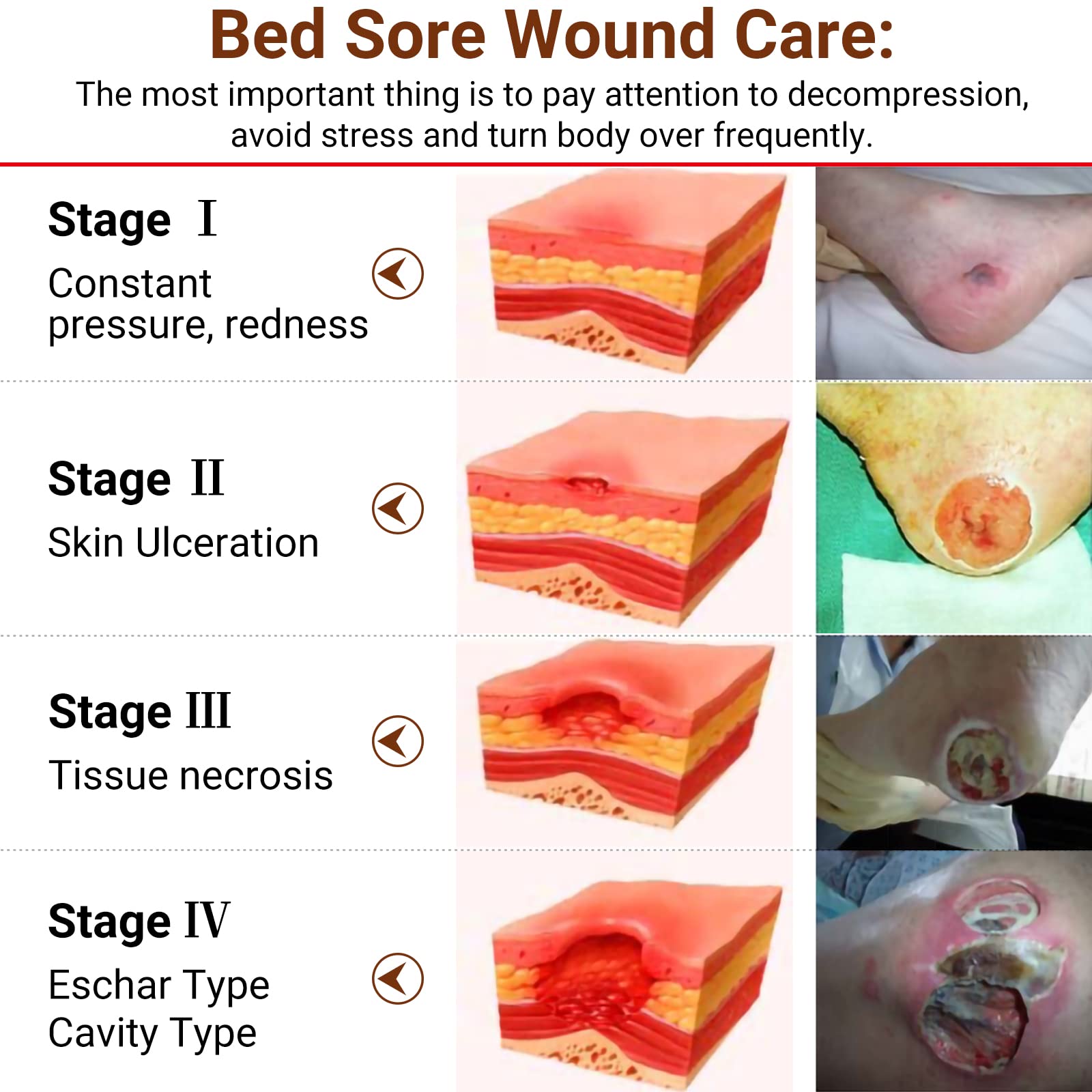 Buy LMNOOP® Bed Sore Cream, Maximum Strength Wound Care Ointment for