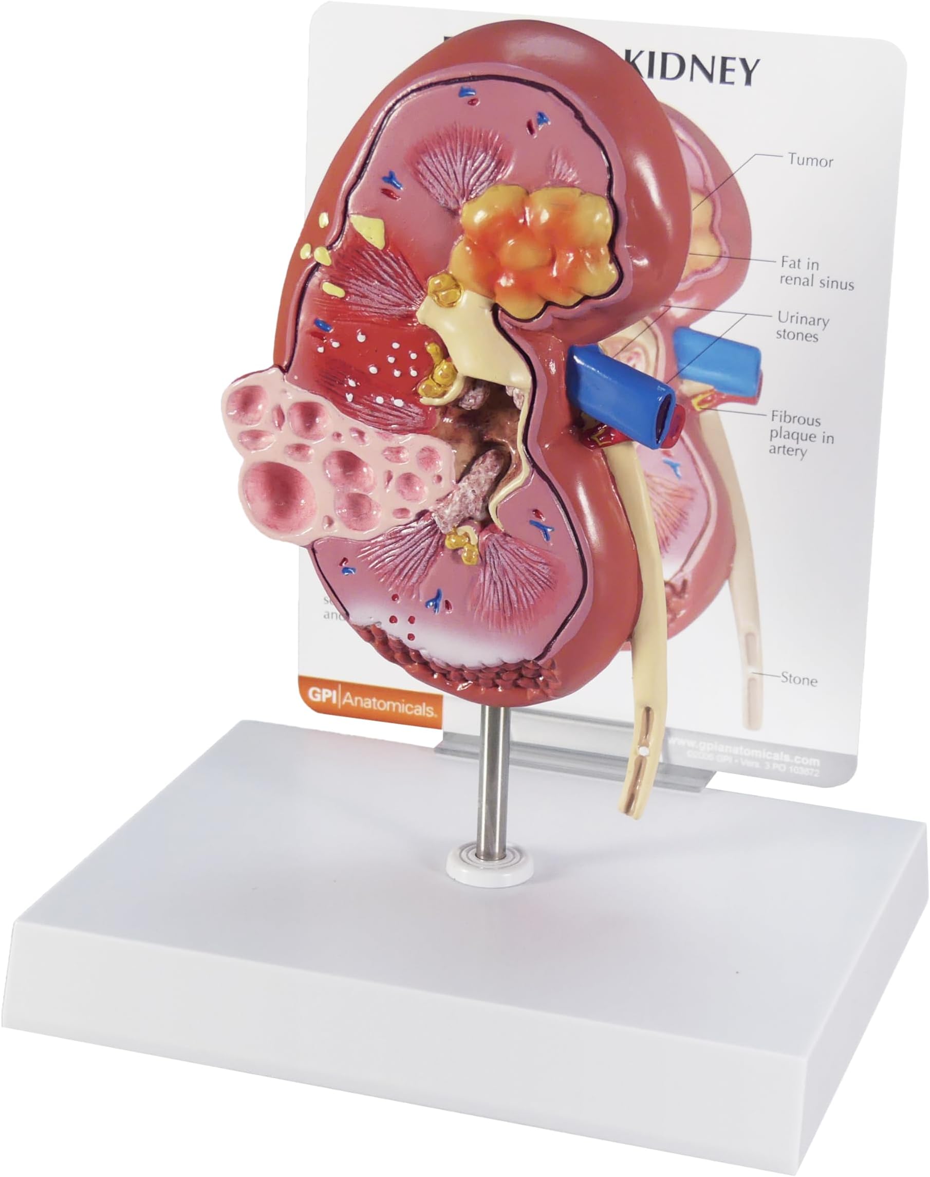 - GPI Anatomicals - Kidney Model, Dual Perspective Replica with Normal and Diseased Kidney for Human Anatomy and Physiology Education, Anatomy Model for Doctor's Offices, Medical Learning Resources