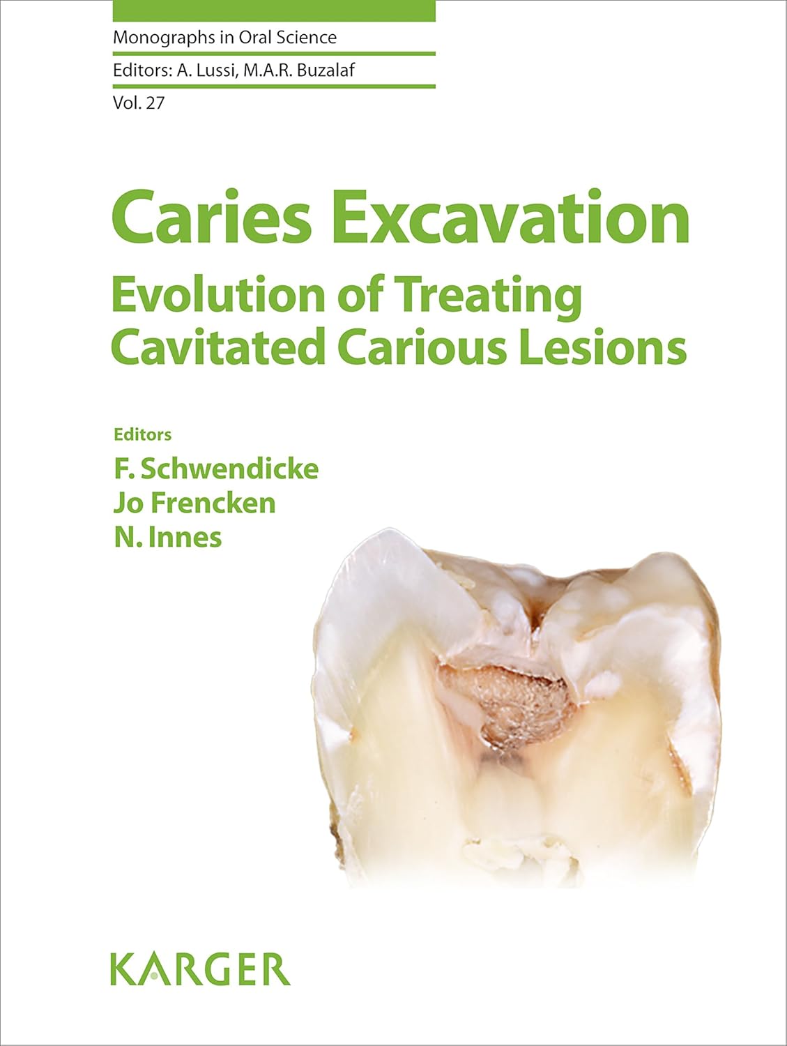 Caries Excavation Evolution of Treating Cavitated Caries Lesions