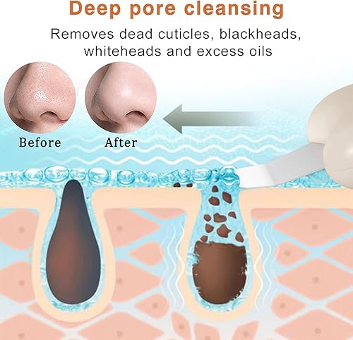 Miniatura 3 de Herramientas de eliminación de puntos negros, raspador de nariz para puntos negros, rascador de poros limpios, herramienta de limpieza profunda