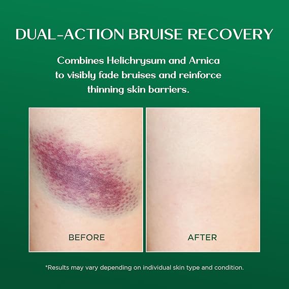 Vigority Arnica Bruise Cream: Extra Strength Arnica Cream for Bruises, Mature & Thin Skin with Helichrysum, Vitamins K, C & E - Soothes, Restores & Strengthens Skin Barrier for Adult & Senior - 3.4oz