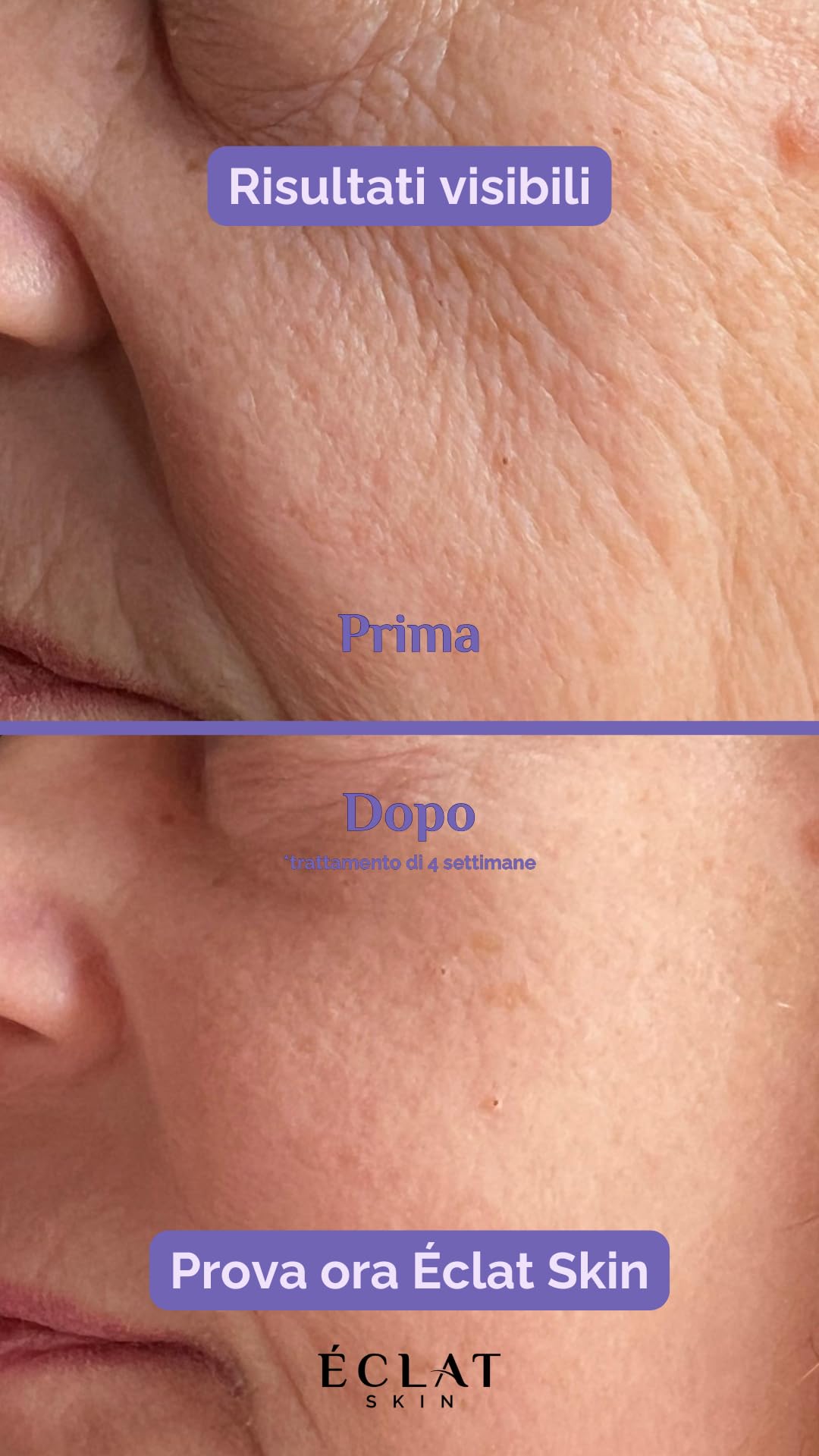Siero Viso Antiage, Azione rimpolpante e antirughe, Effetto Filler, con Acido Ialuronico, Peptidi, Estratti Naturali, Ideale per Tutti i Tipi di Pelle, 30ML