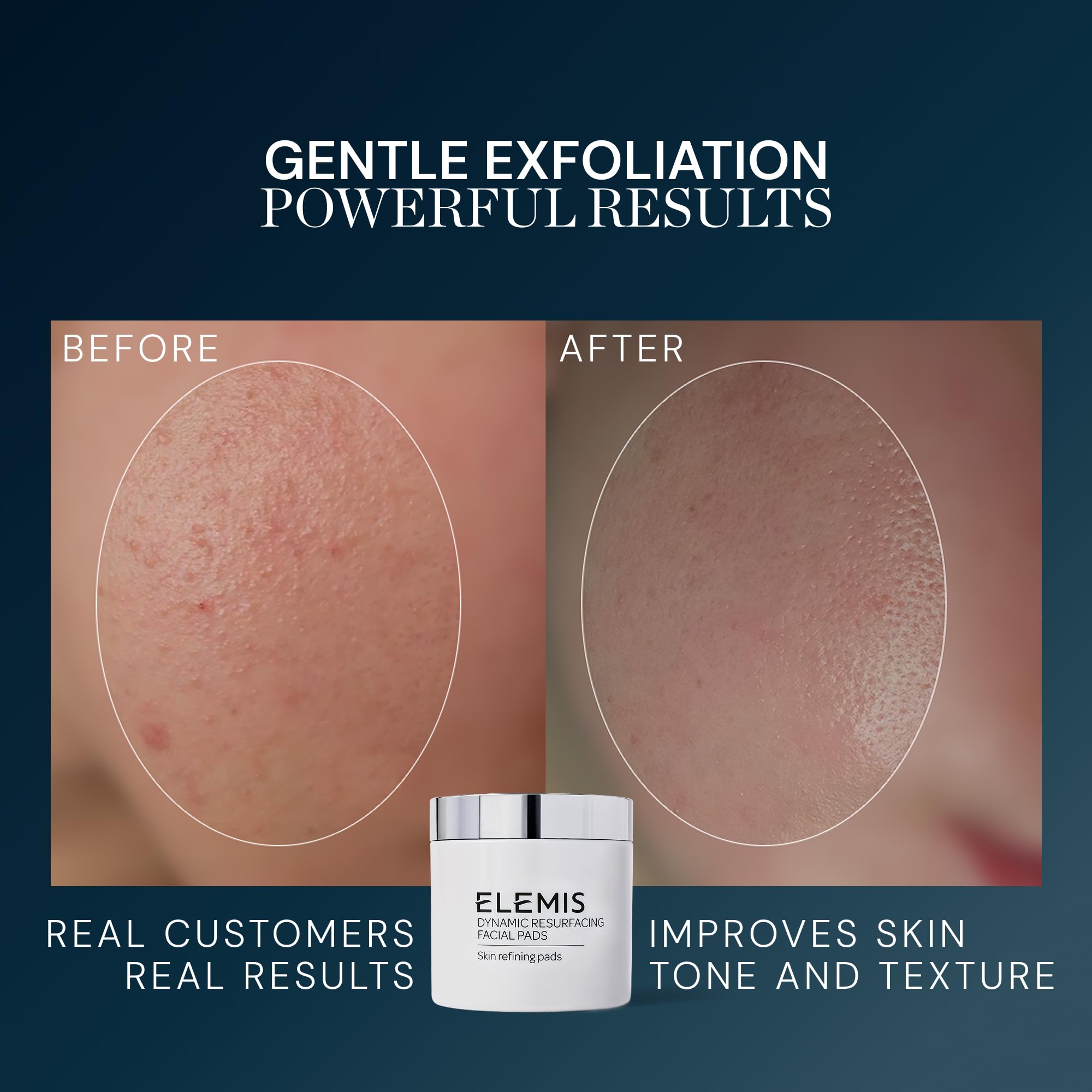 Elemis Resurfacing Facial Pads - Gentle Glow -4