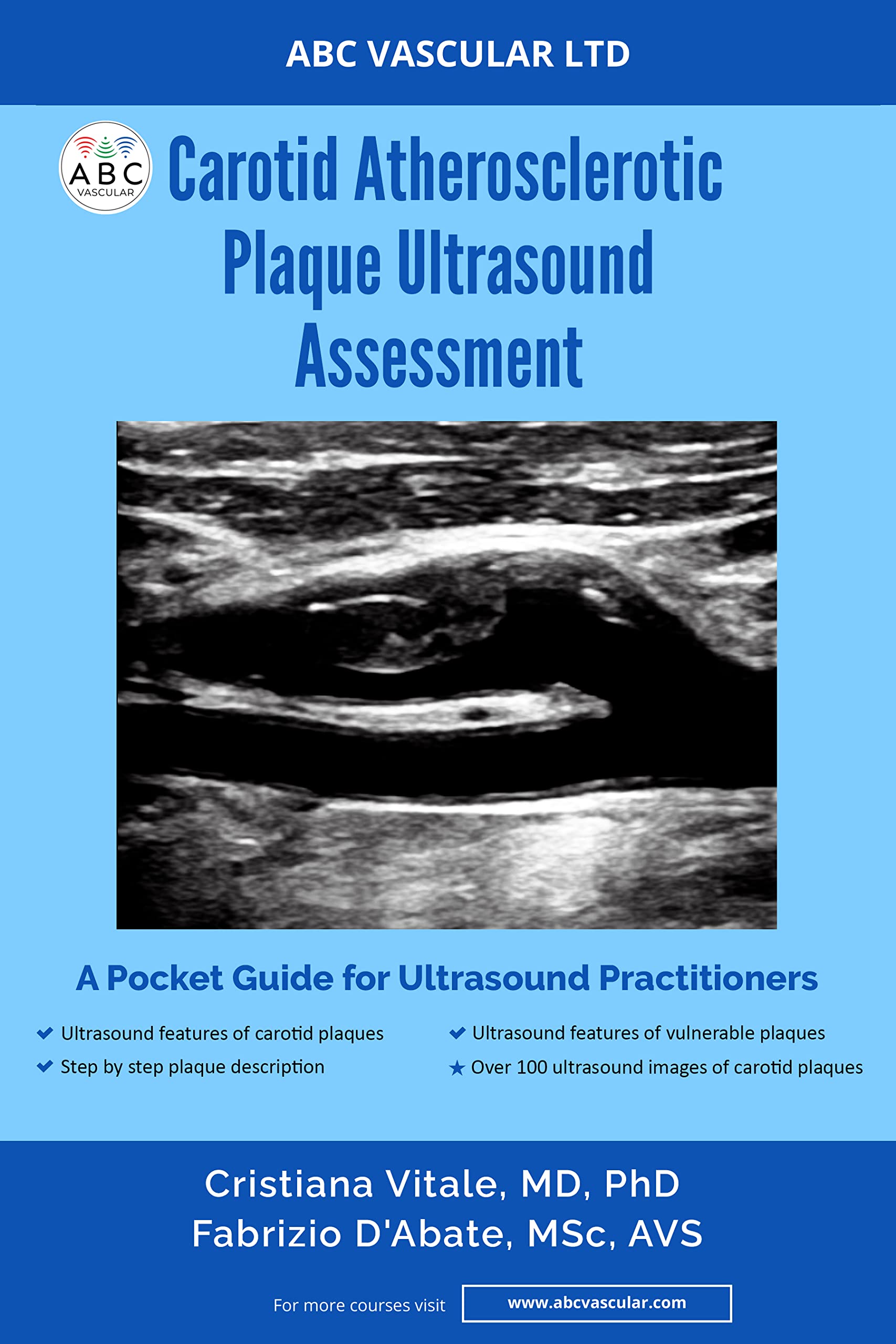 Carotid Atherosclerotic Plaque Ultrasound Assessment: A Pocket Guide for Ultrasound Practitioners (English Edition)