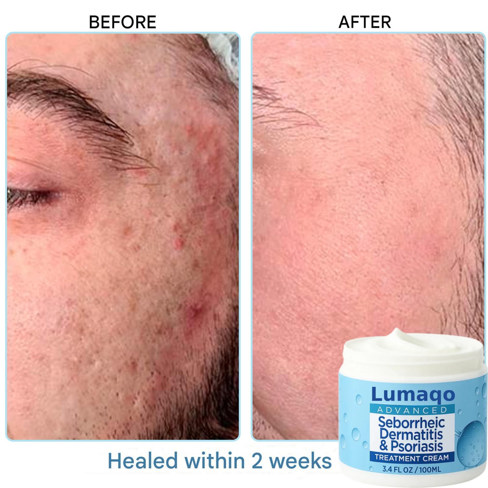 Lumaqo Crema Barba Dermatitis,Hidratación Natural,Fórmula Suave Para Pieles Sensibles Y Secas,Para Todo Tipo De Piel (3 Caja) - 3