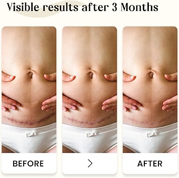 Dermatix Silicone Scar Gel 60g | Professional Scar Treatment for Surgery, Burns & Injuries – Clinically Proven to Reduce the Appearance of Scars