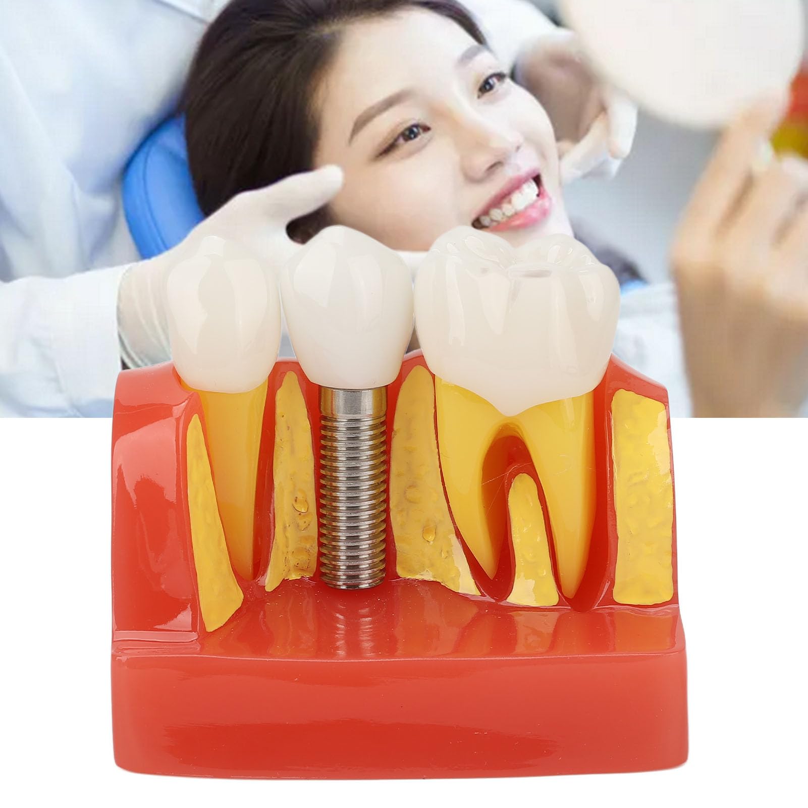 Modelo de implante Dental con Corona y Puente extraíbles para demostración y formación