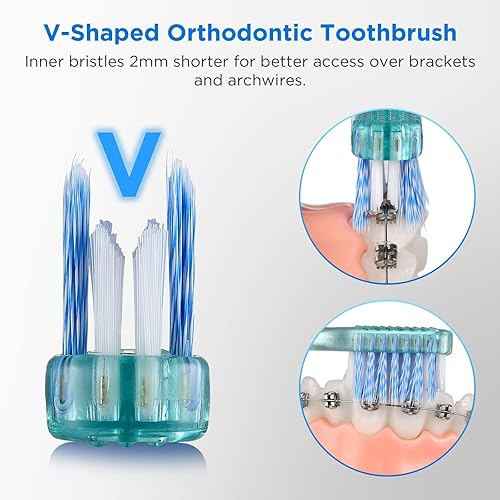 Miniatura 2 de Fregum Cepillo de dientes ortodóntico en forma de V+A para aparatos ortopédicos, con 6 cepillos interdentales, cerdas suaves, 6 unidades