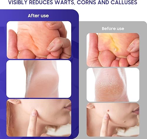 Miniatura 3 de luanerl Removedor de verrugas y maíz, 20% ácido salicílico con fórmula natural, congelación de máxima resistencia, acción rápida para verrugas,