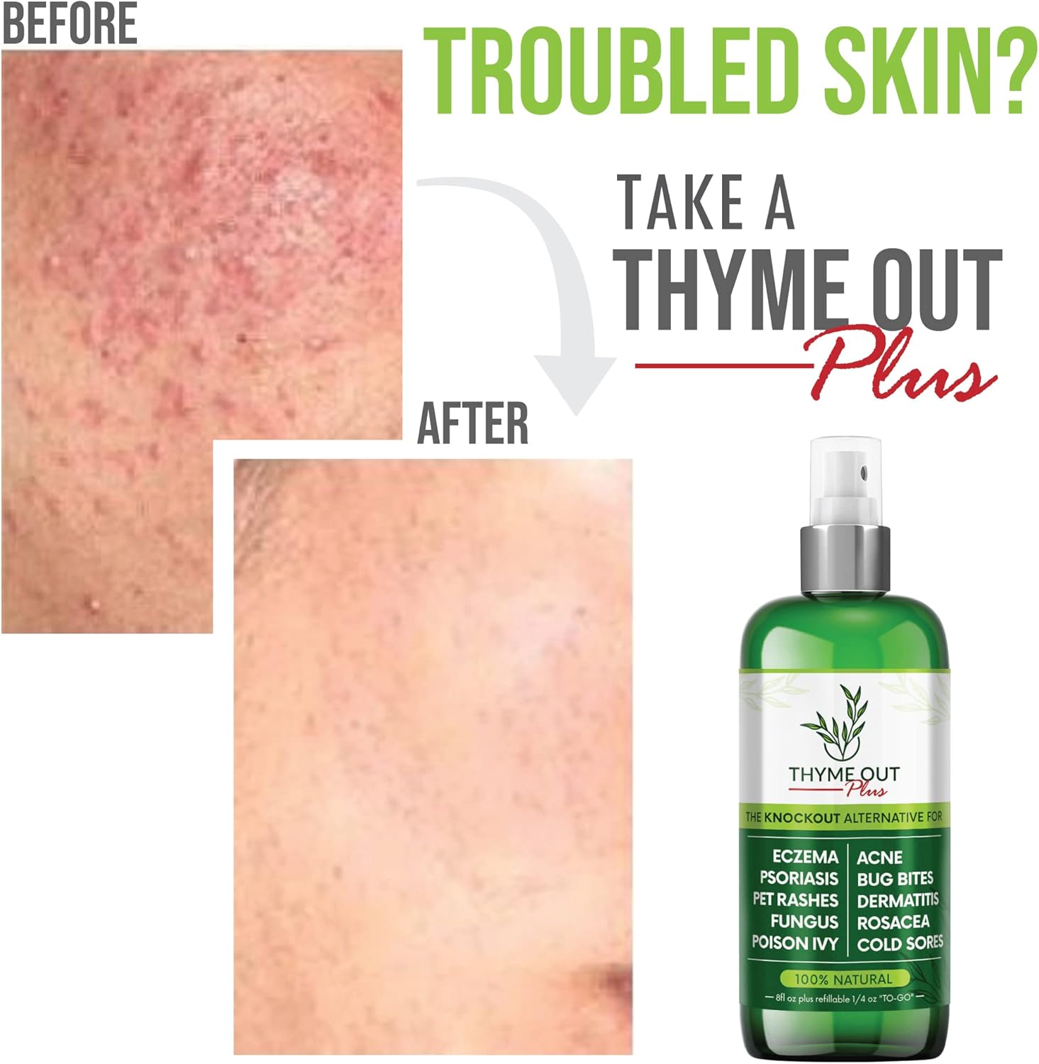 Buy Thyme Out Plus Eczema Treatment, Psoriasis Treatment Treats Acne