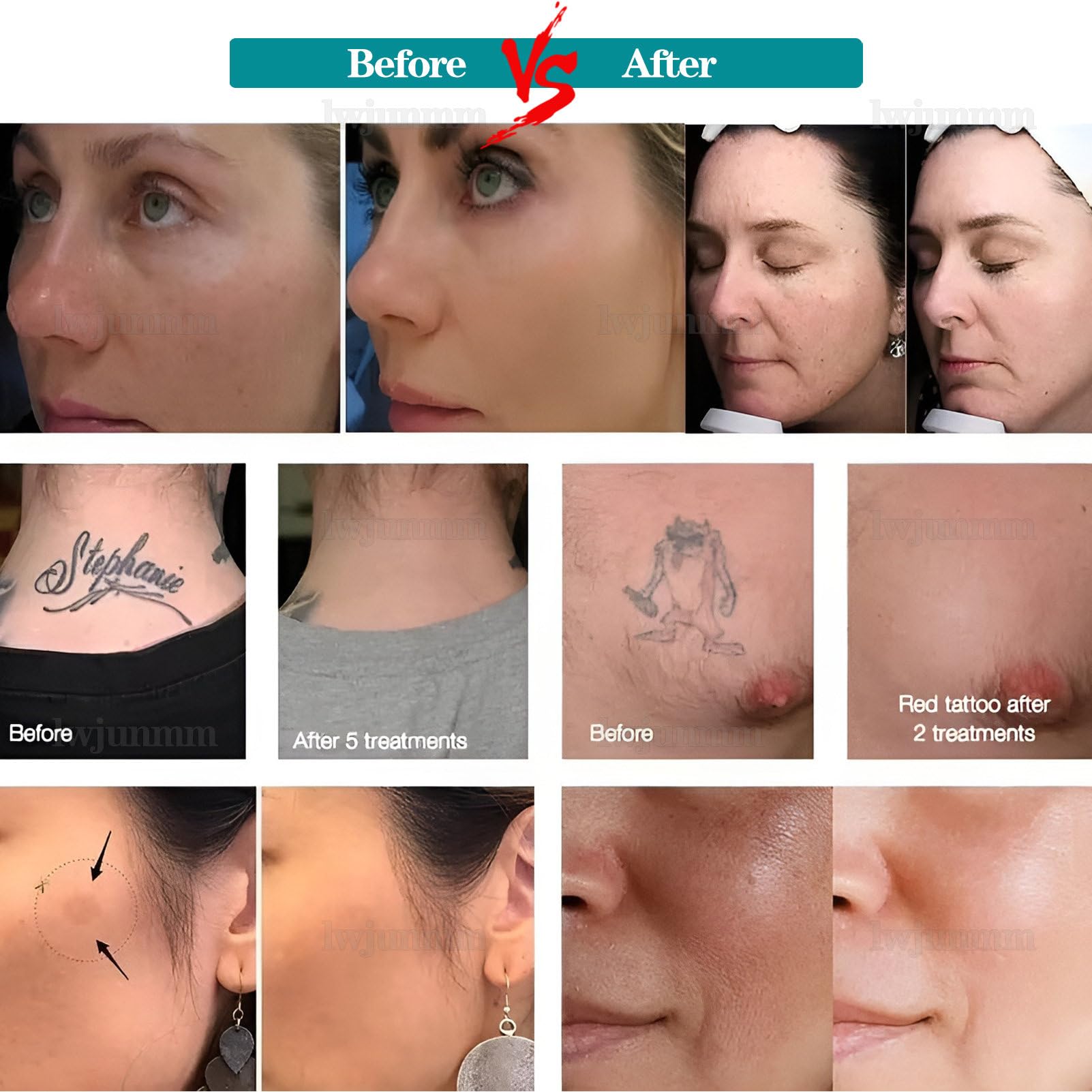 Tattooentfernungsgerät, Pico-Laser-Gerät zur Tattooentfernung, zur Entfernung von Tattoos und Farbflecken an Augenbrauen und Lidstrich 5Probes