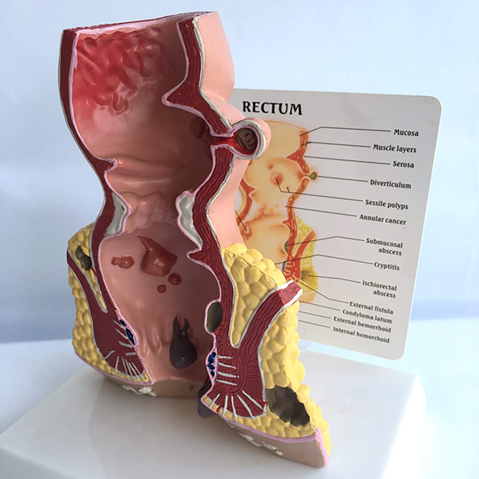Modell Der Menschlichen Rektalen Pathologie, Modell Der Rektalen HäMorrhoidenpathologie, Modell Der Menschlichen Rektalen Anatomie, Medizinische Lehrmittel