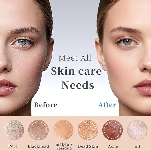 Miniatura 3 de Herramientas removedoras de puntos negros, removedor de cabeza negra para cara y nariz, espátula facial, limpiador de poros profundos para el